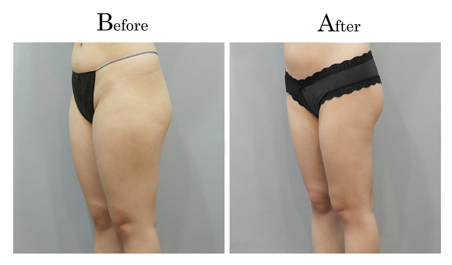 台中大腿抽脂手術,大腿環抽,邱智弘抽脂手術,Vaser威塑抽脂1_02