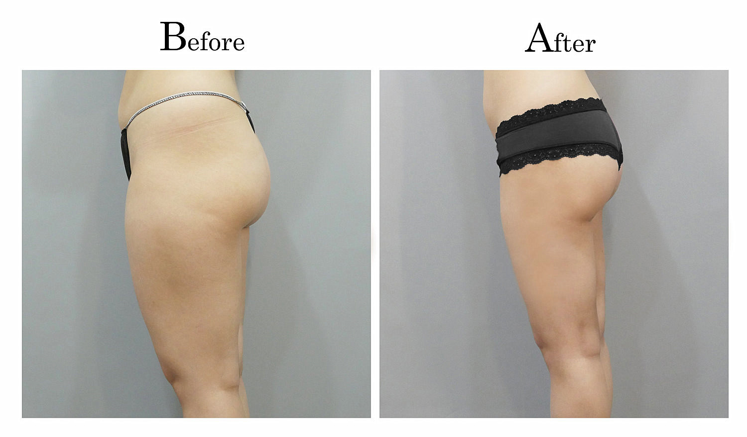 台中大腿抽脂手術,大腿環抽,邱智弘抽脂手術,Vaser威塑抽脂1_03