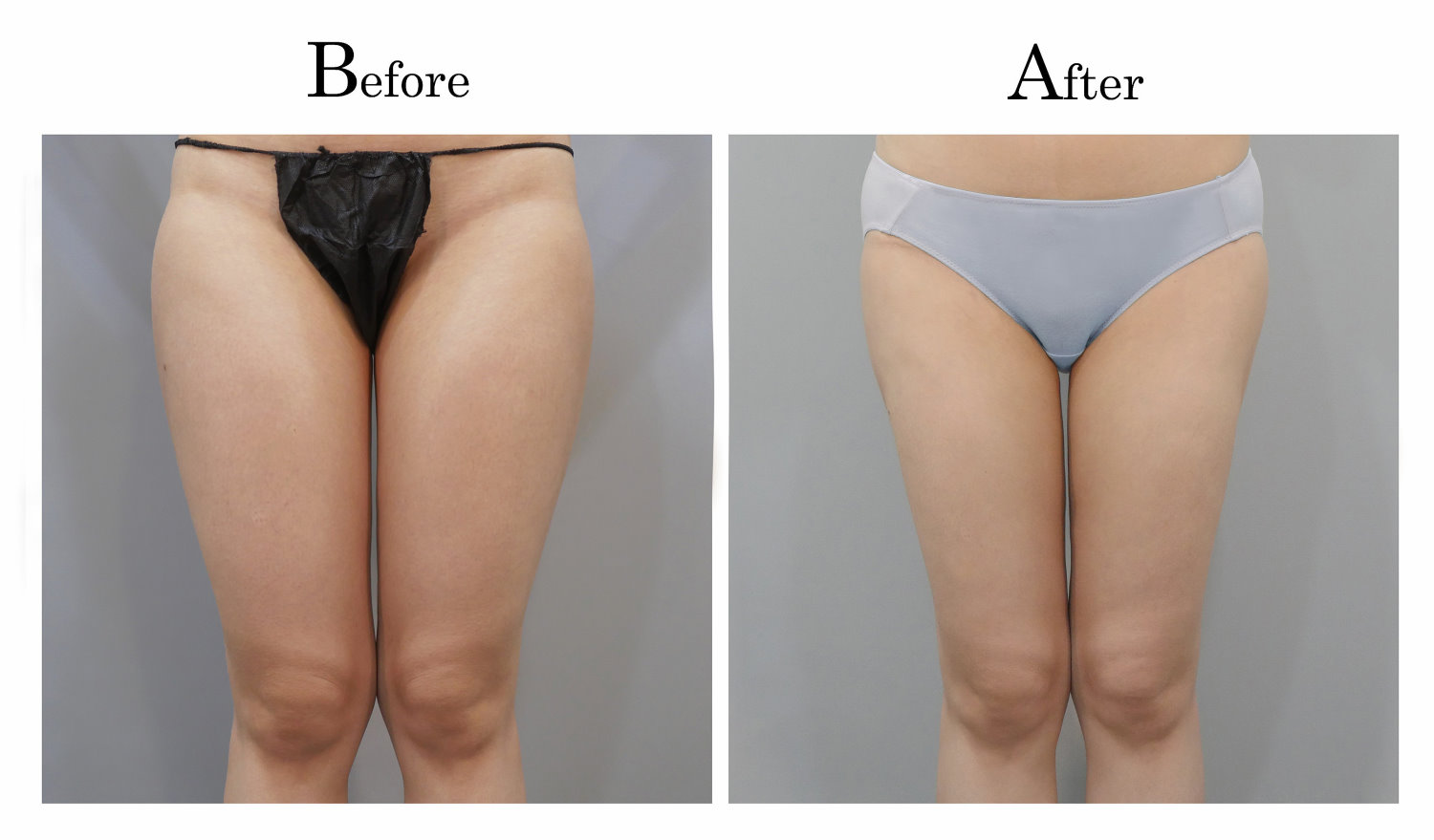 台中大腿抽脂手術,大腿環抽,邱智弘抽脂手術,Vaser威塑抽脂3_01