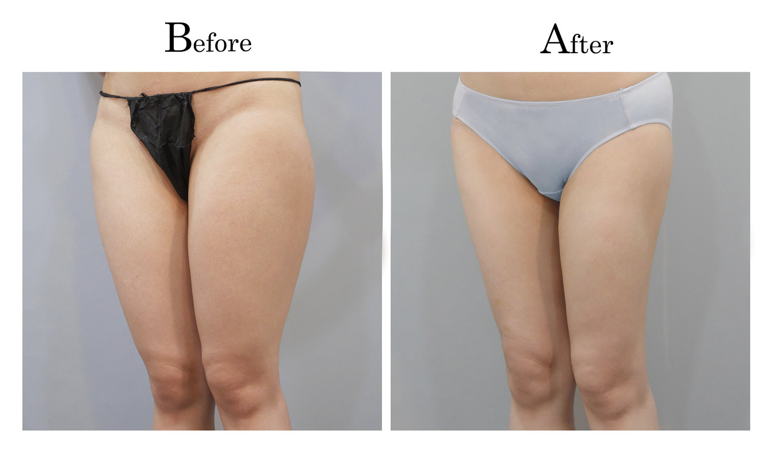 台中大腿抽脂手術,大腿環抽,邱智弘抽脂手術,Vaser威塑抽脂3_02