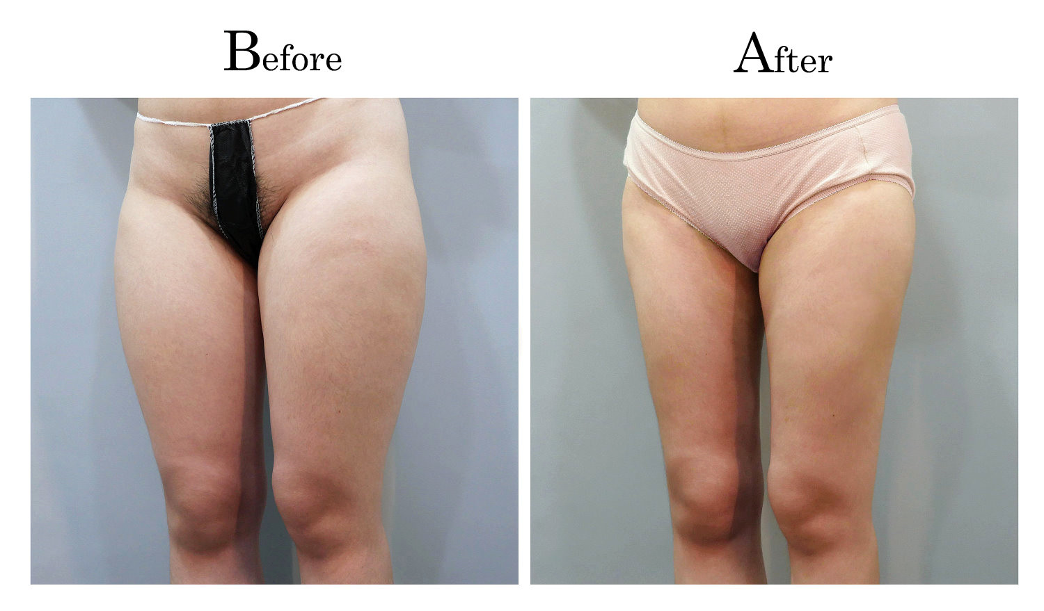 台中大腿抽脂手術,大腿環抽,邱智弘抽脂手術,Vaser威塑抽脂4_02