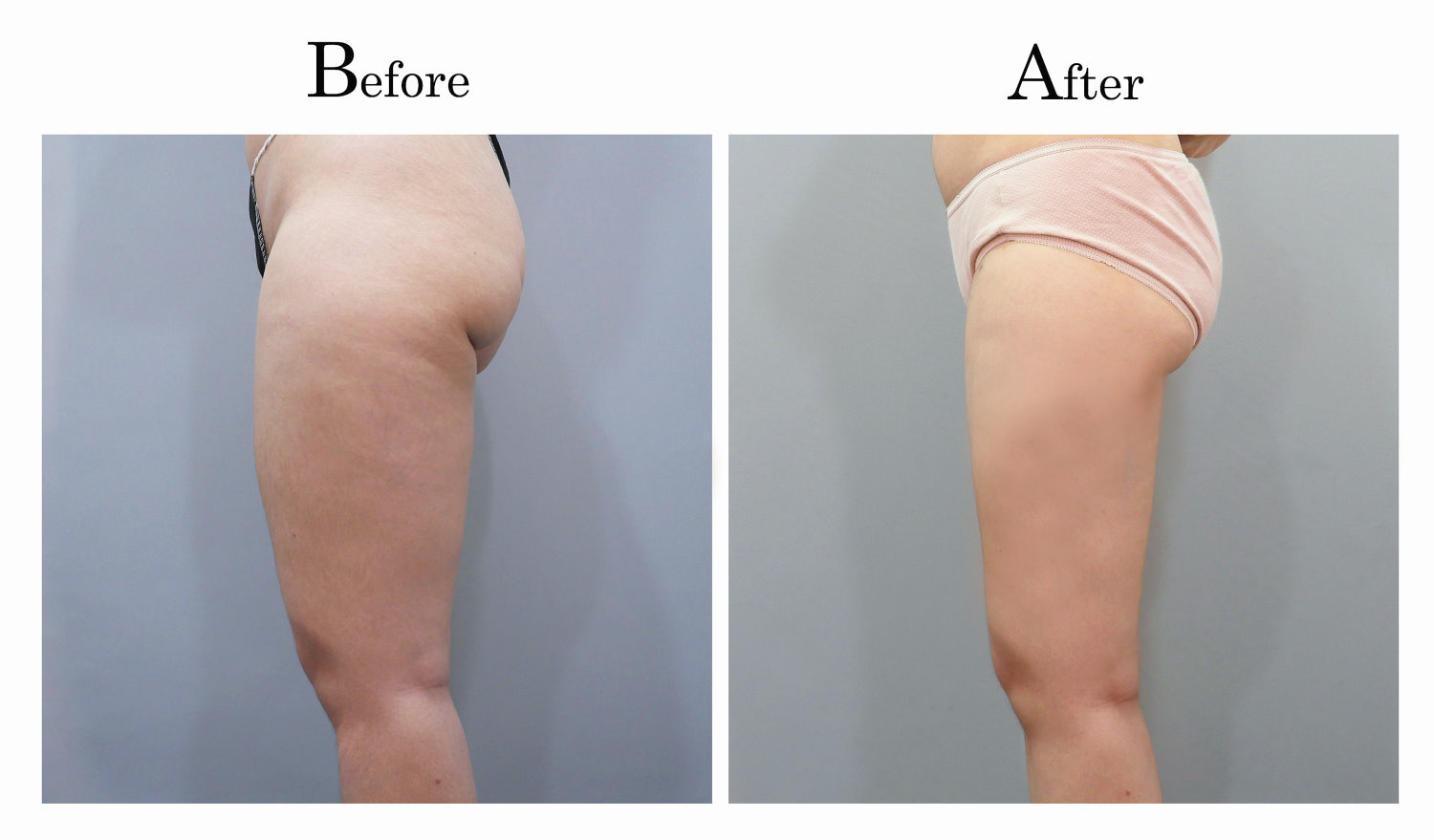 台中大腿抽脂手術,大腿環抽,邱智弘抽脂手術,Vaser威塑抽脂4_03