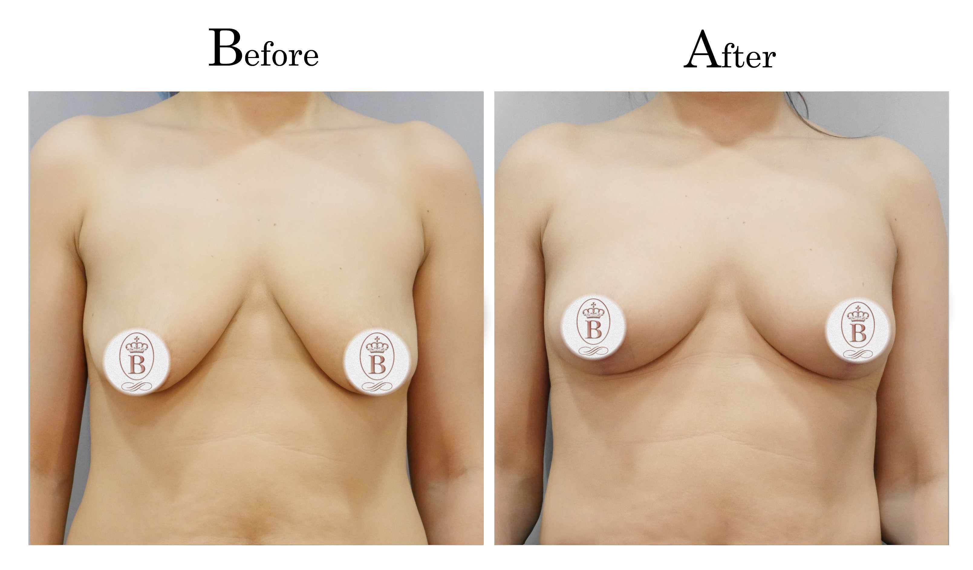 台中提乳手術,教主提乳手術,乳房下垂鬆弛提乳01_1