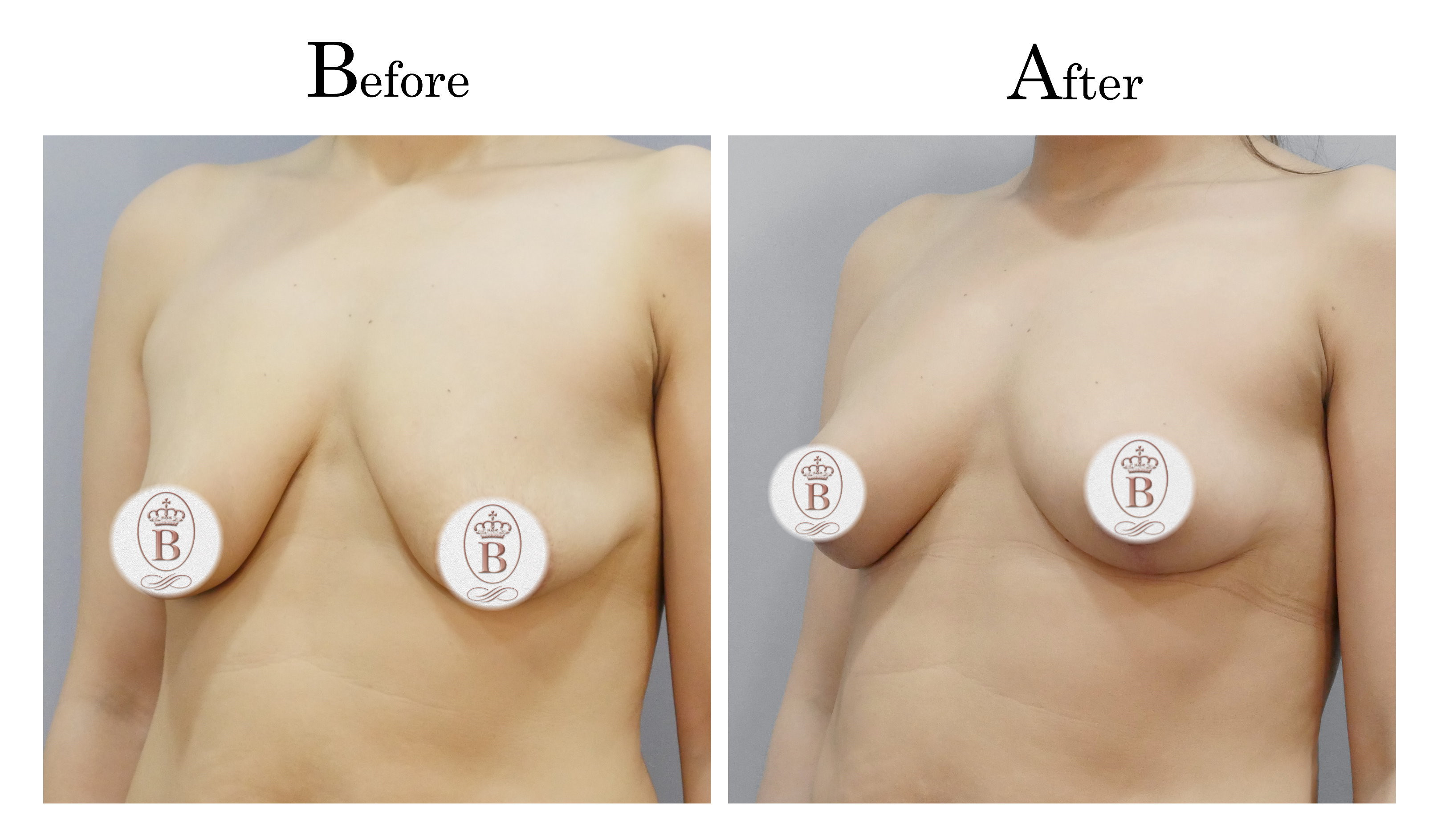 台中提乳手術,教主提乳手術,乳房下垂鬆弛提乳01_2