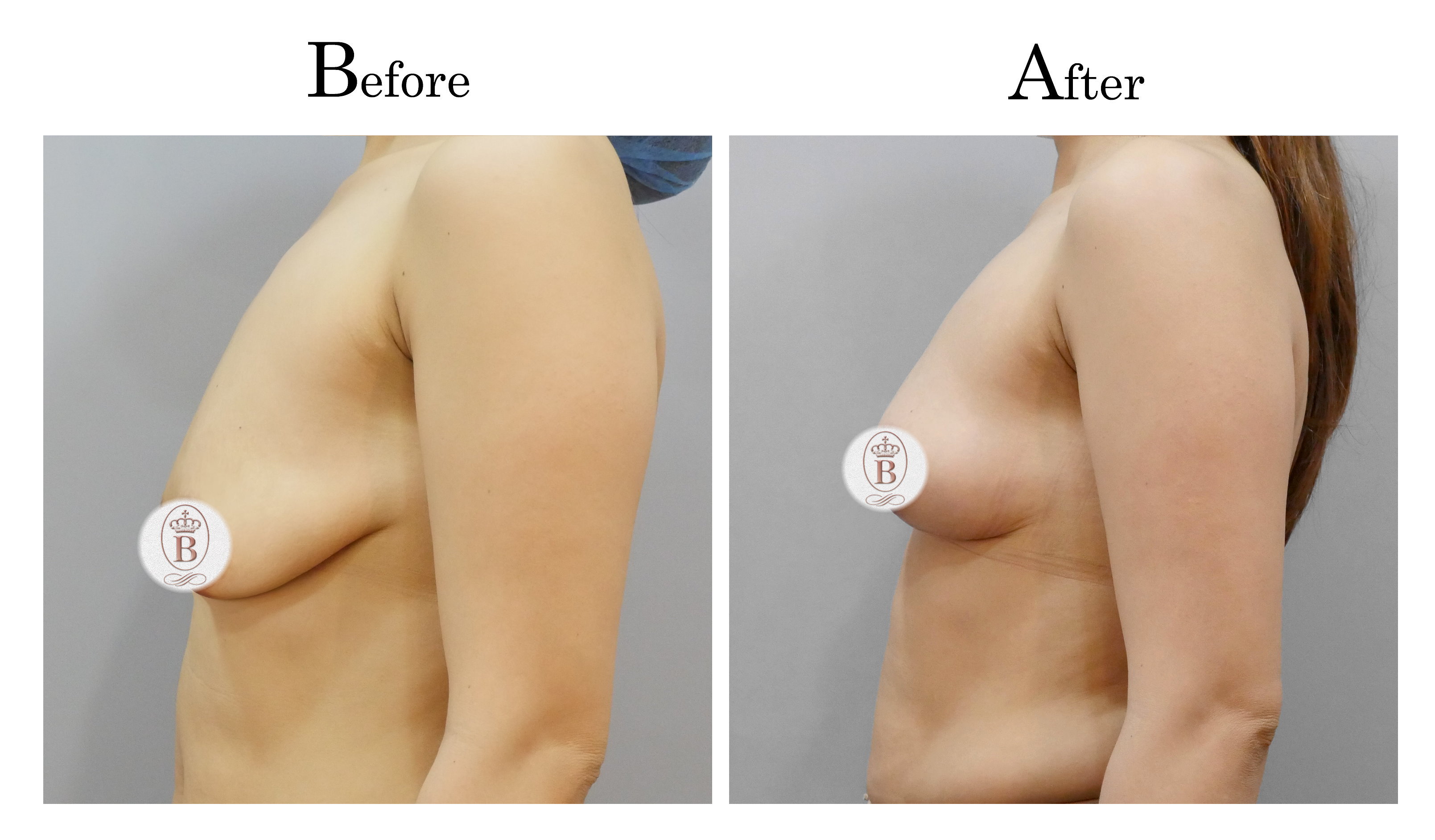 台中提乳手術,教主提乳手術,乳房下垂鬆弛提乳01_3