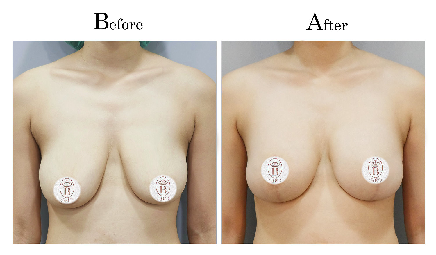 台中提乳手術,教主提乳手術,乳房下垂鬆弛提乳02_1