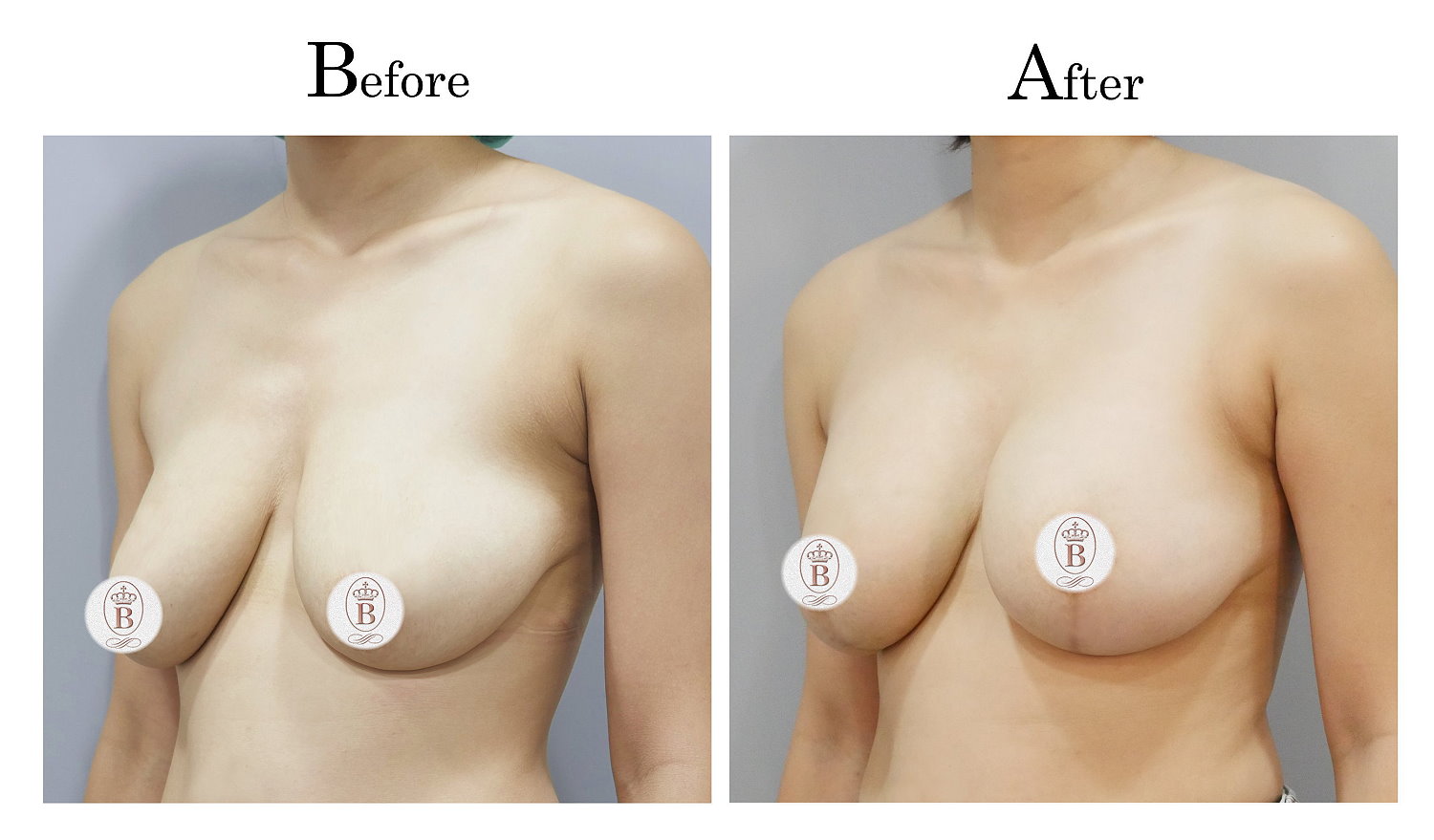 台中提乳手術,教主提乳手術,乳房下垂鬆弛提乳02_2