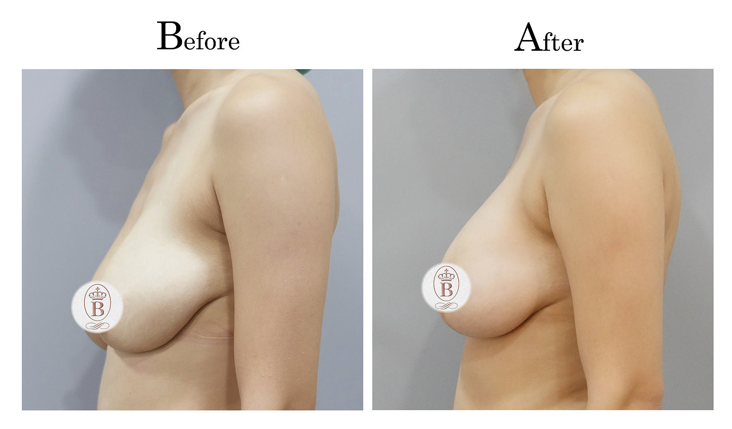 台中提乳手術,教主提乳手術,乳房下垂鬆弛提乳02_3