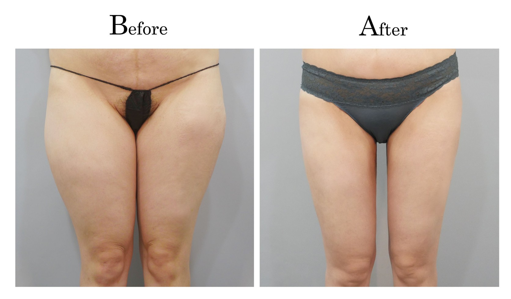 台中大腿抽脂手術,大腿環抽,邱智弘抽脂手術,Vaser威塑抽脂5_01