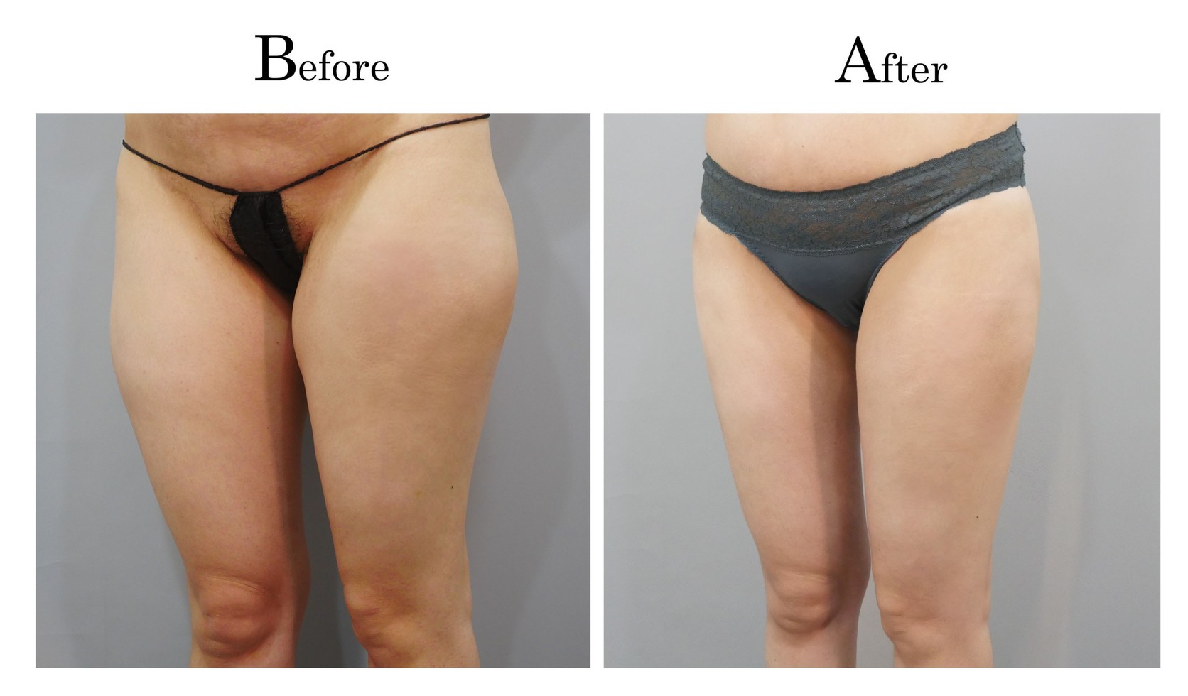 台中大腿抽脂手術,大腿環抽,邱智弘抽脂手術,Vaser威塑抽脂5_02