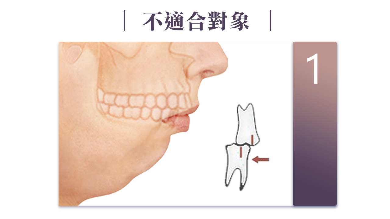 墊下巴手術不適合對象