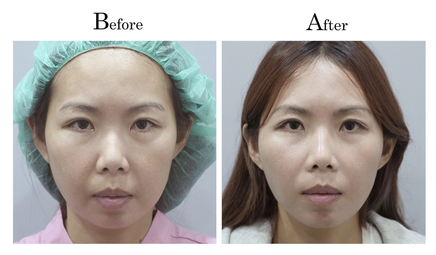 台中臉部埋線拉提拉皮案例005