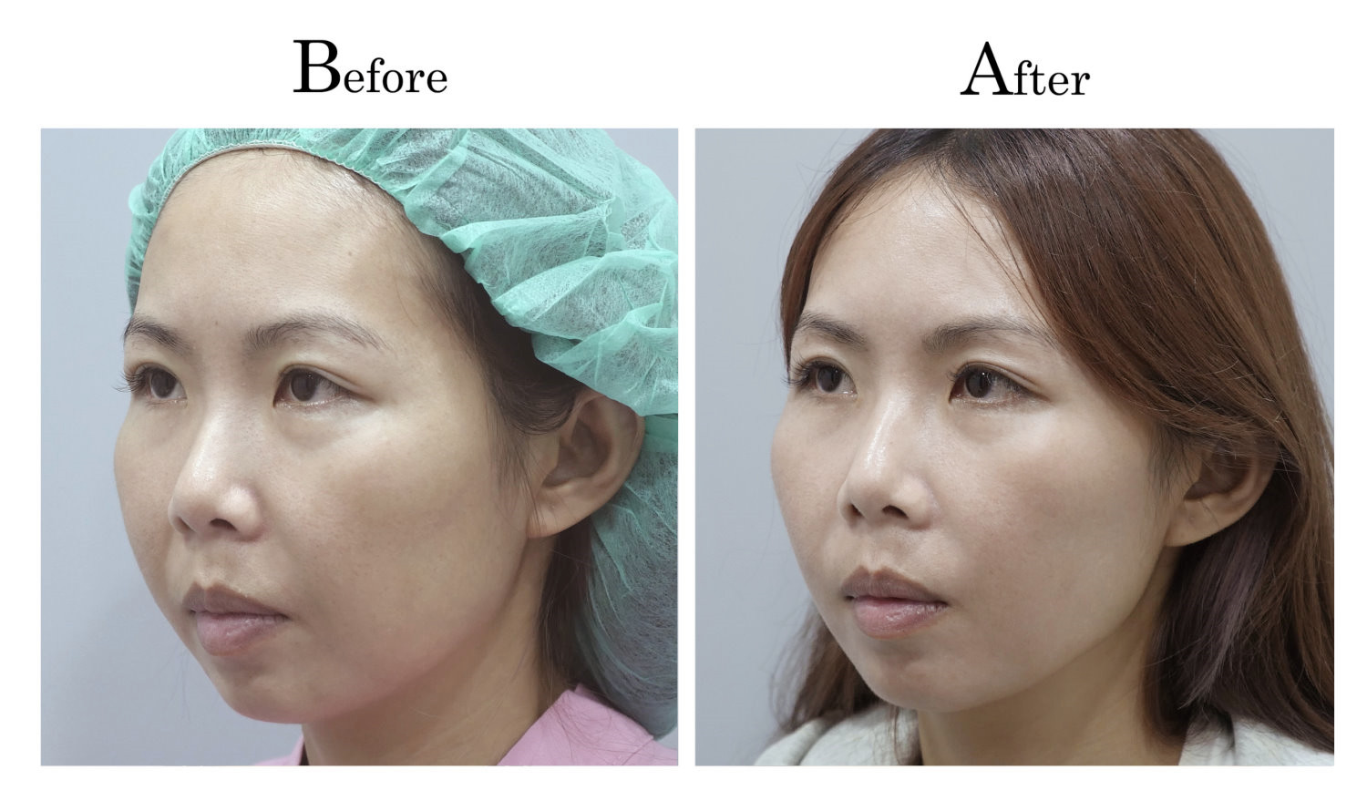 台中臉部埋線拉提拉皮案例006