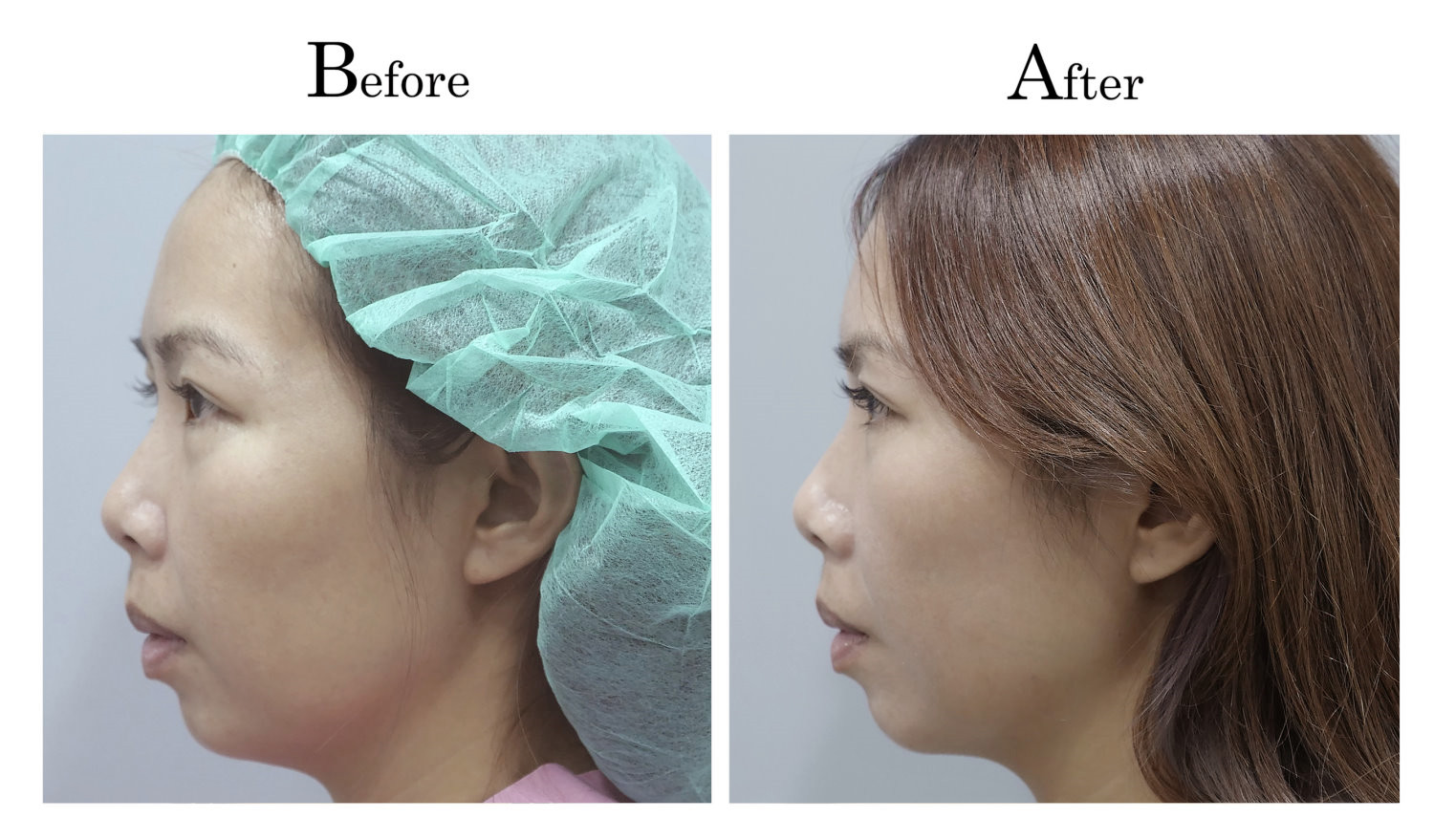 台中臉部埋線拉提拉皮案例007