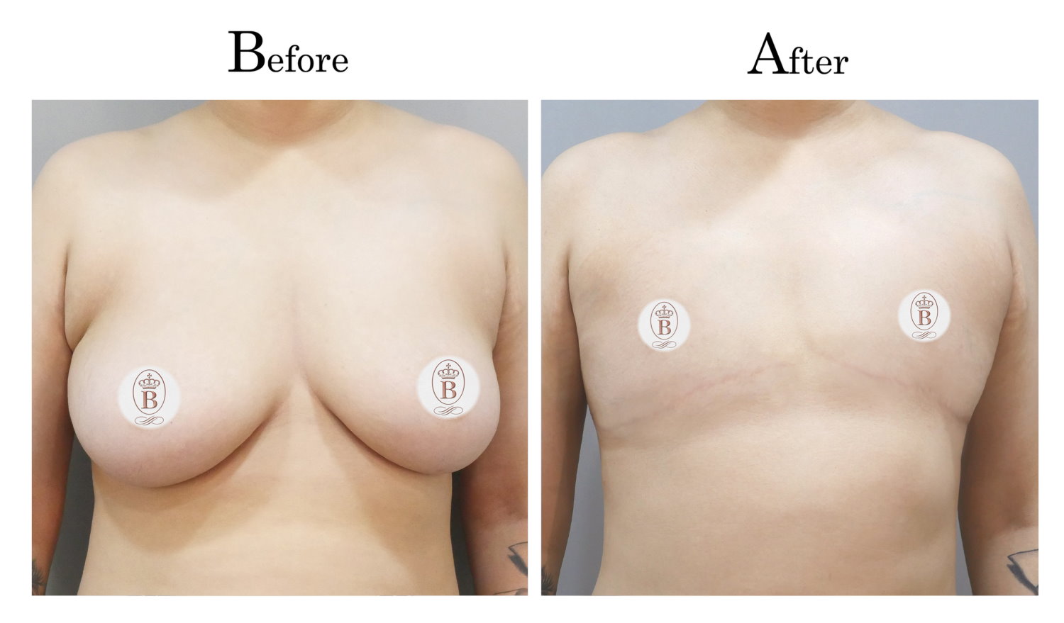 平胸術前術後比較