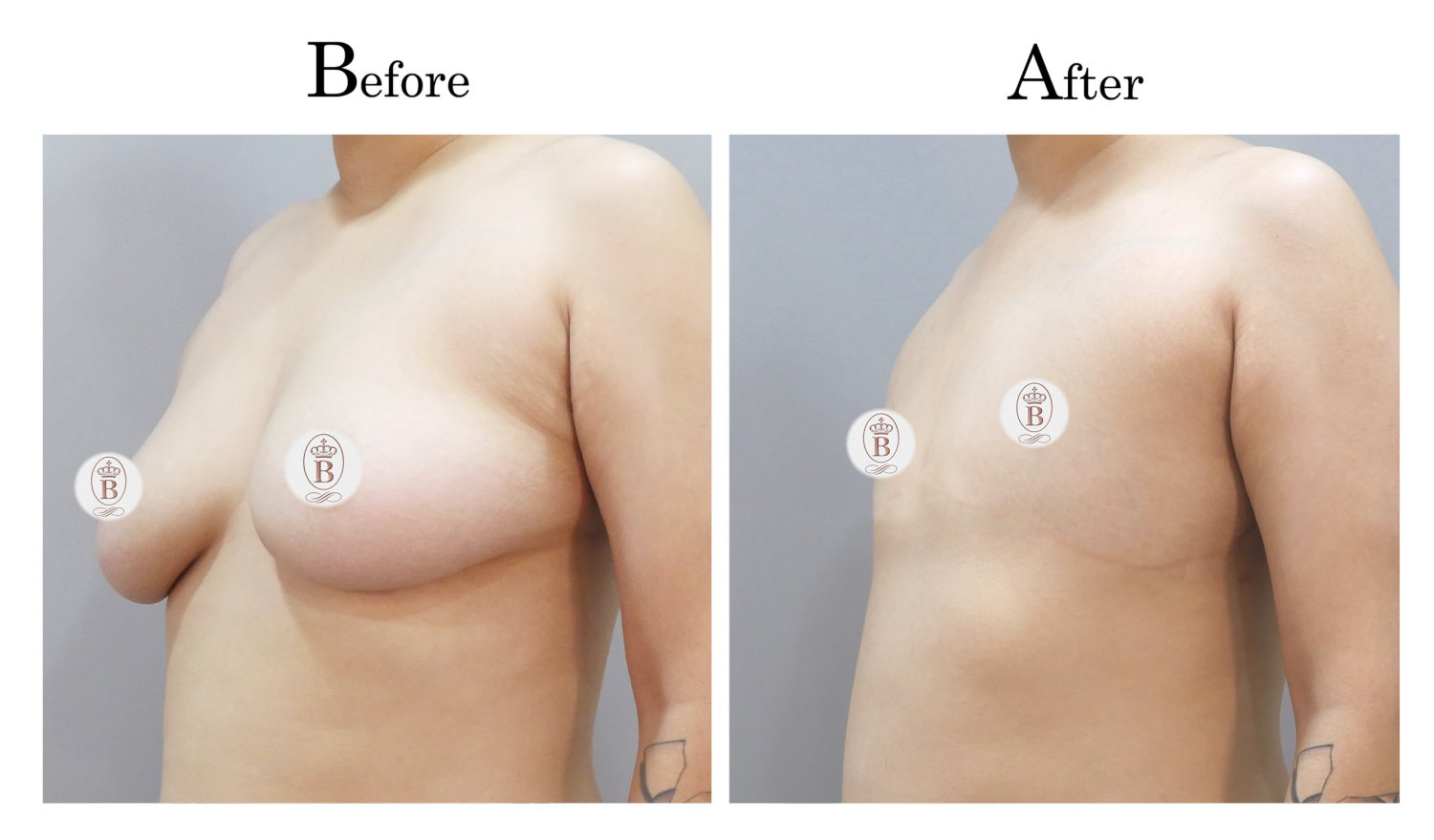 平胸術前術後比較