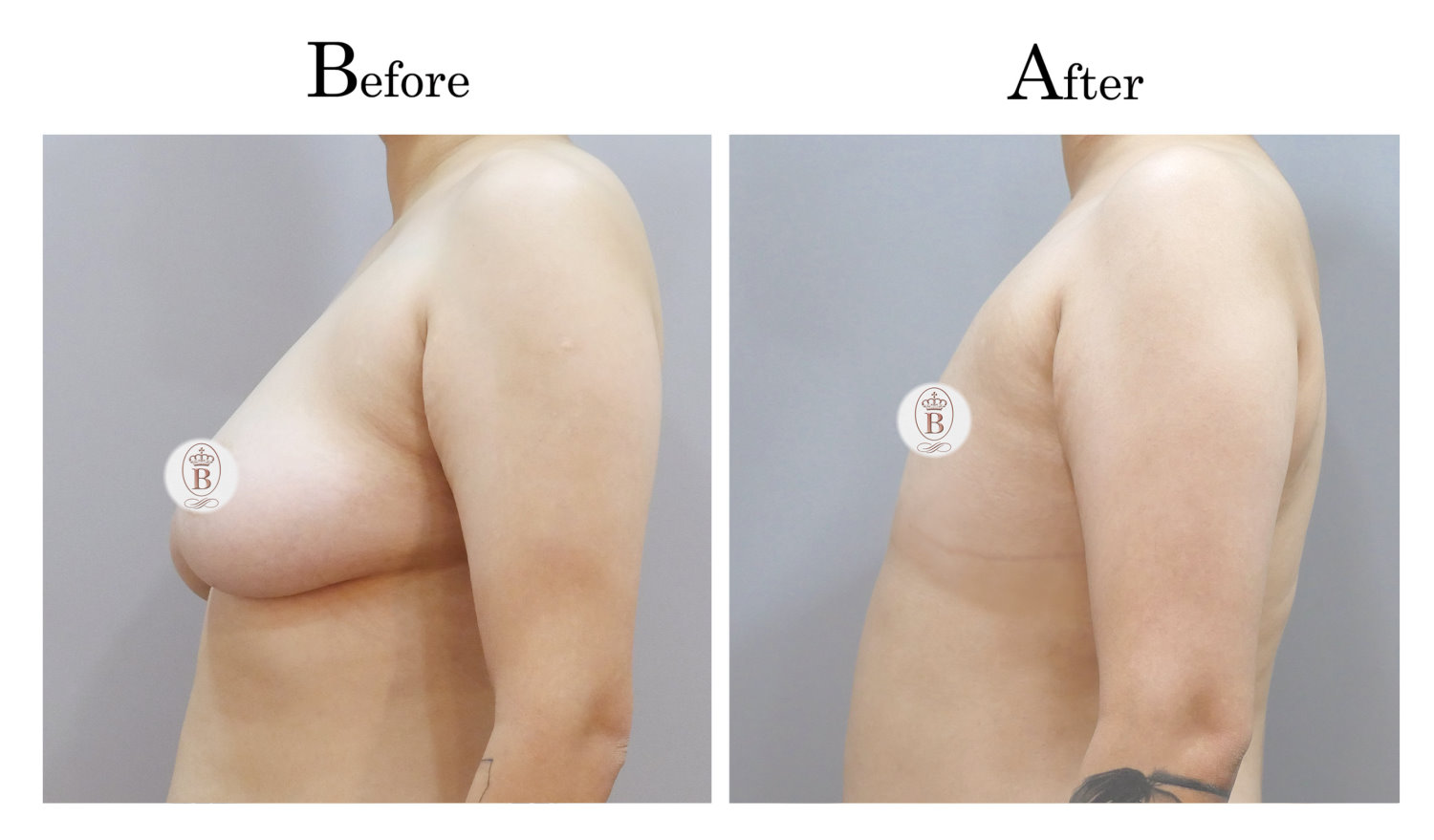 平胸術前術後比較