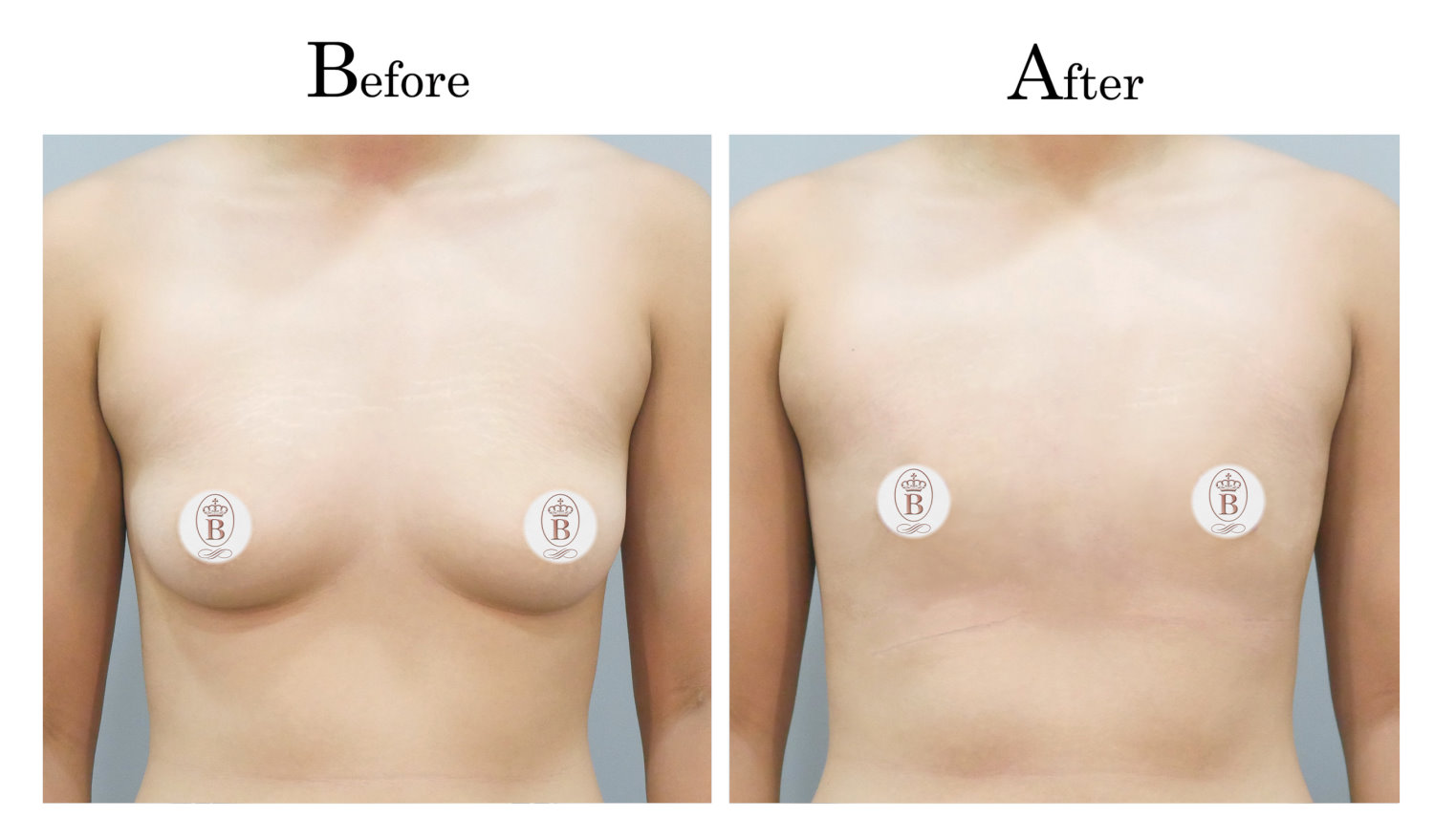 平胸術前術後比較