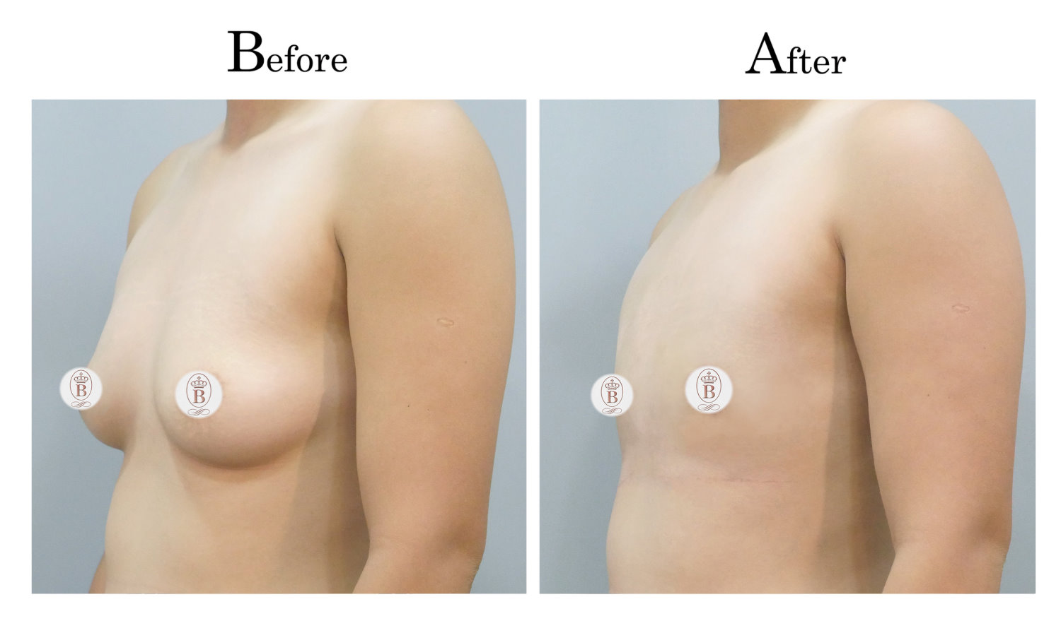 平胸術前術後比較