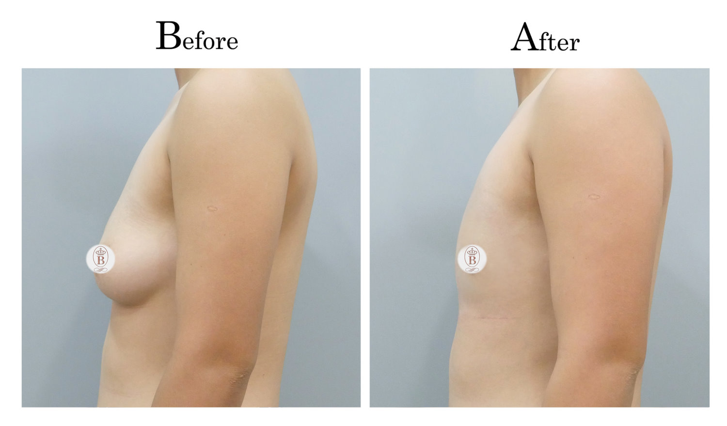 平胸術前術後比較