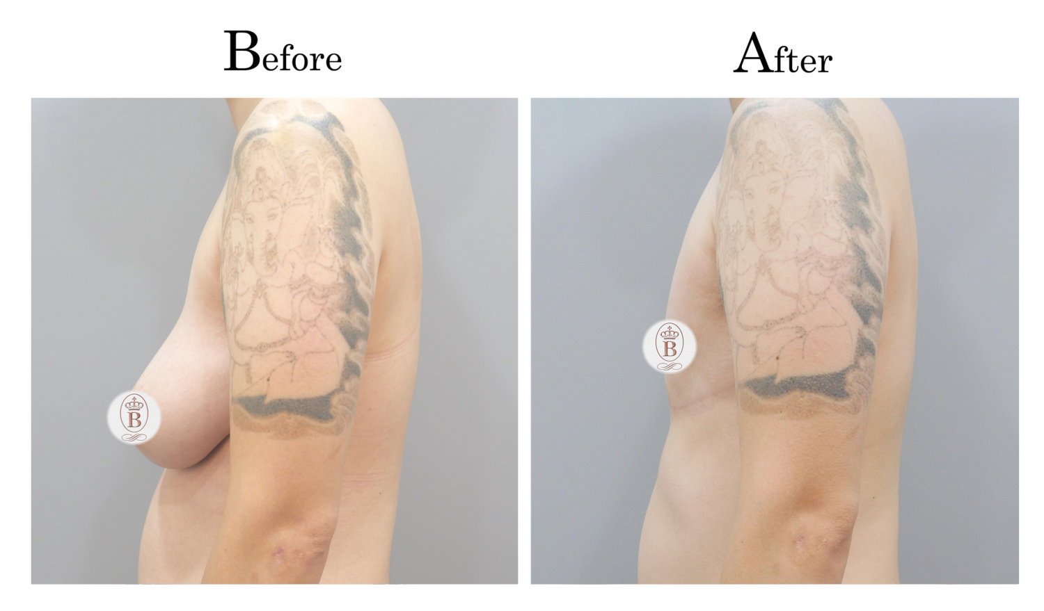 平胸術前術後比較