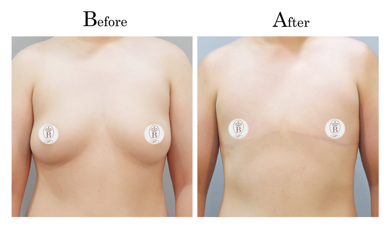 平胸術前術後比較