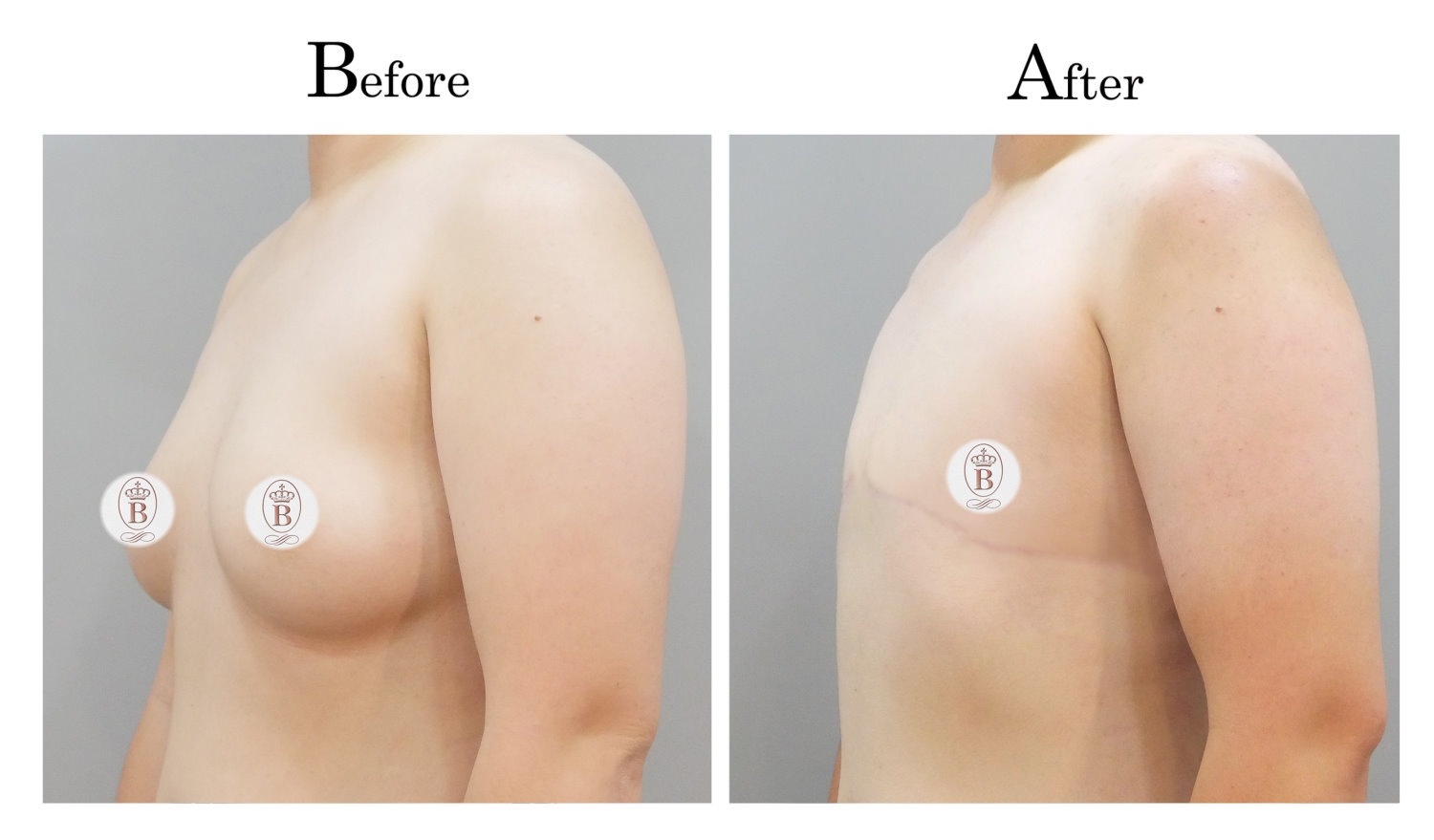 平胸術前術後比較