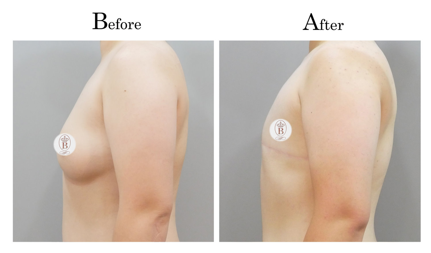 平胸術前術後比較