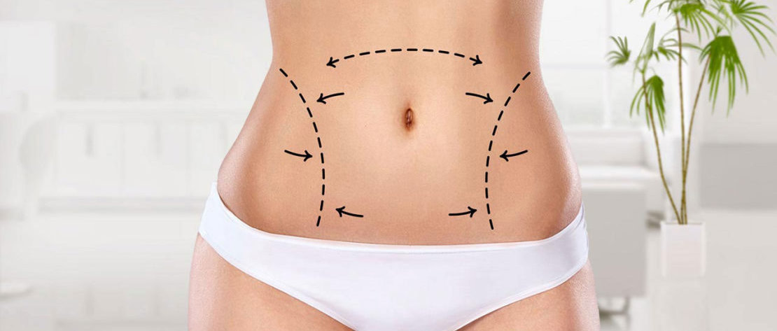 台中水刀抽脂02