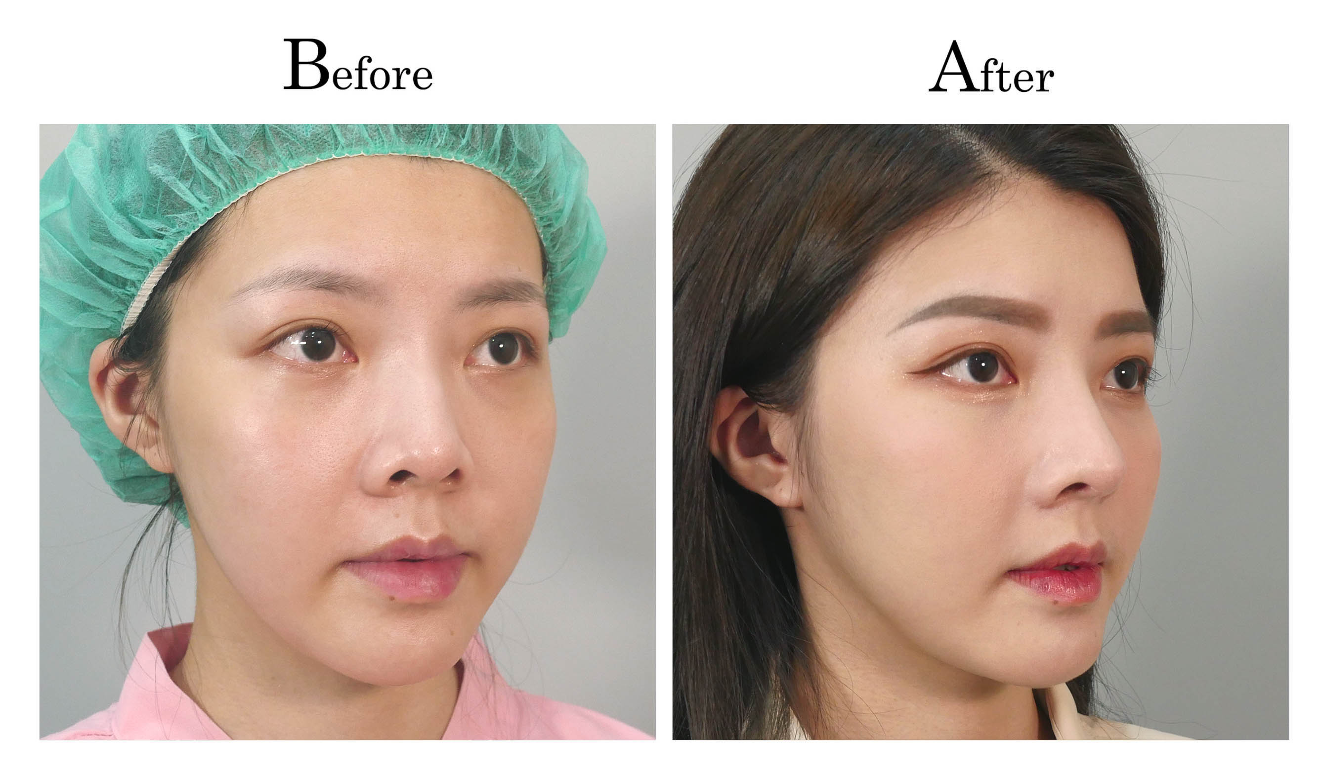 台中隆鼻手術,台中鼻整形,朱立箴隆鼻01_2