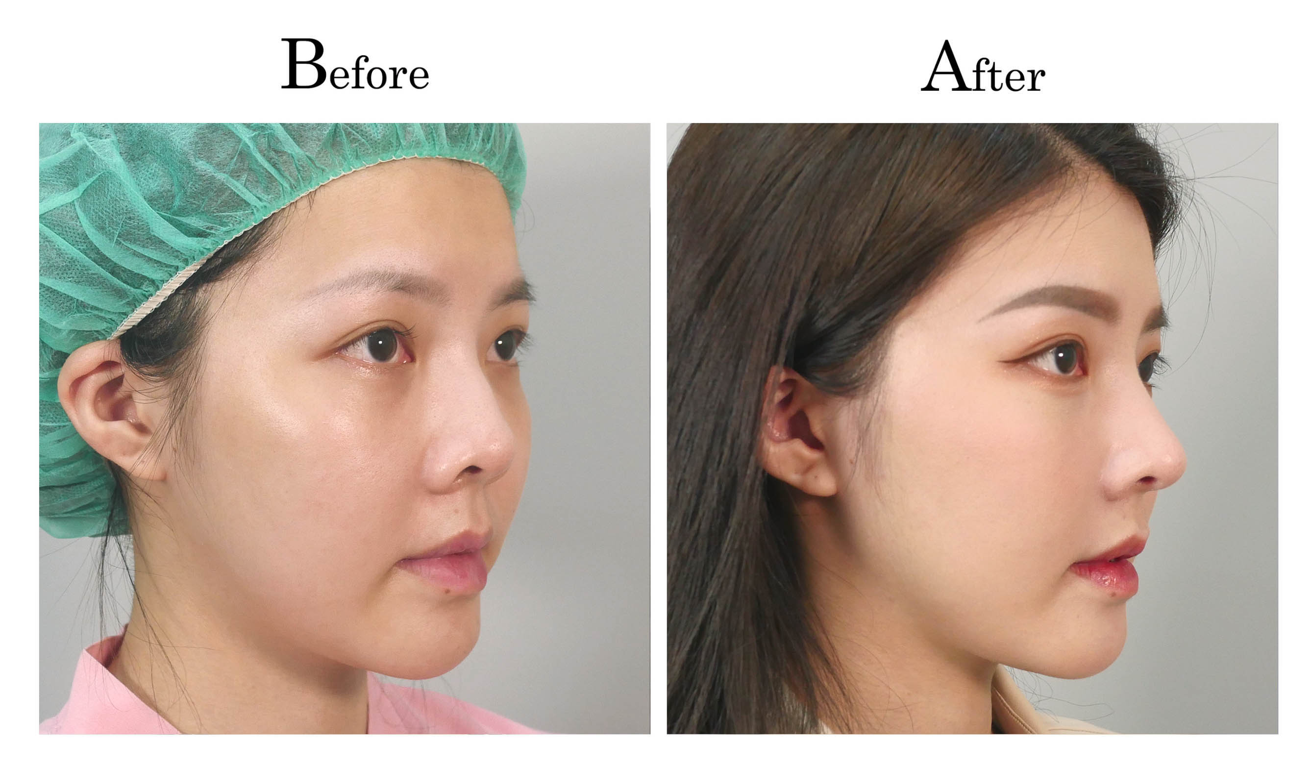 台中隆鼻手術,台中鼻整形,朱立箴隆鼻01_3