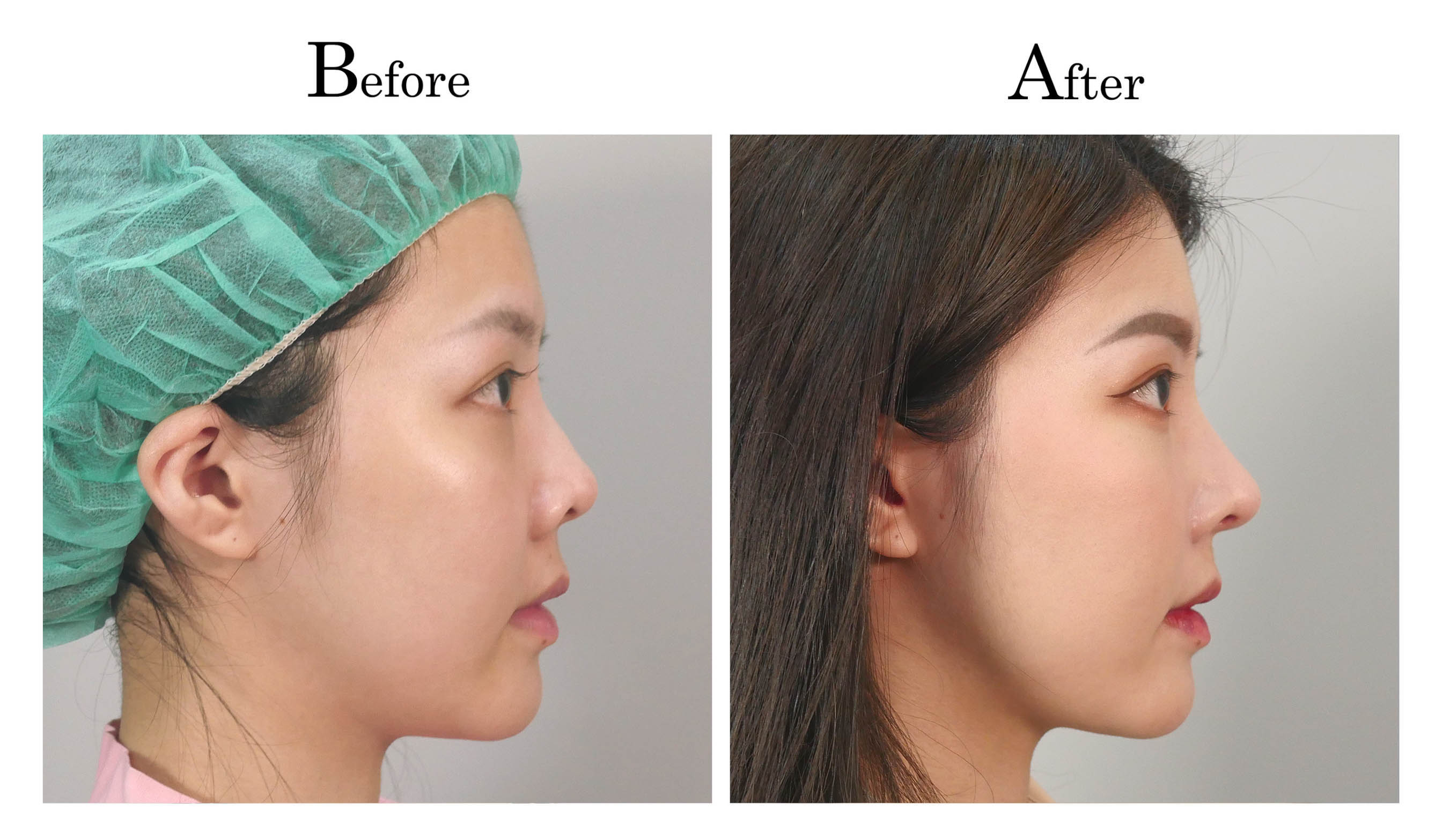 台中隆鼻手術,台中鼻整形,朱立箴隆鼻01_4