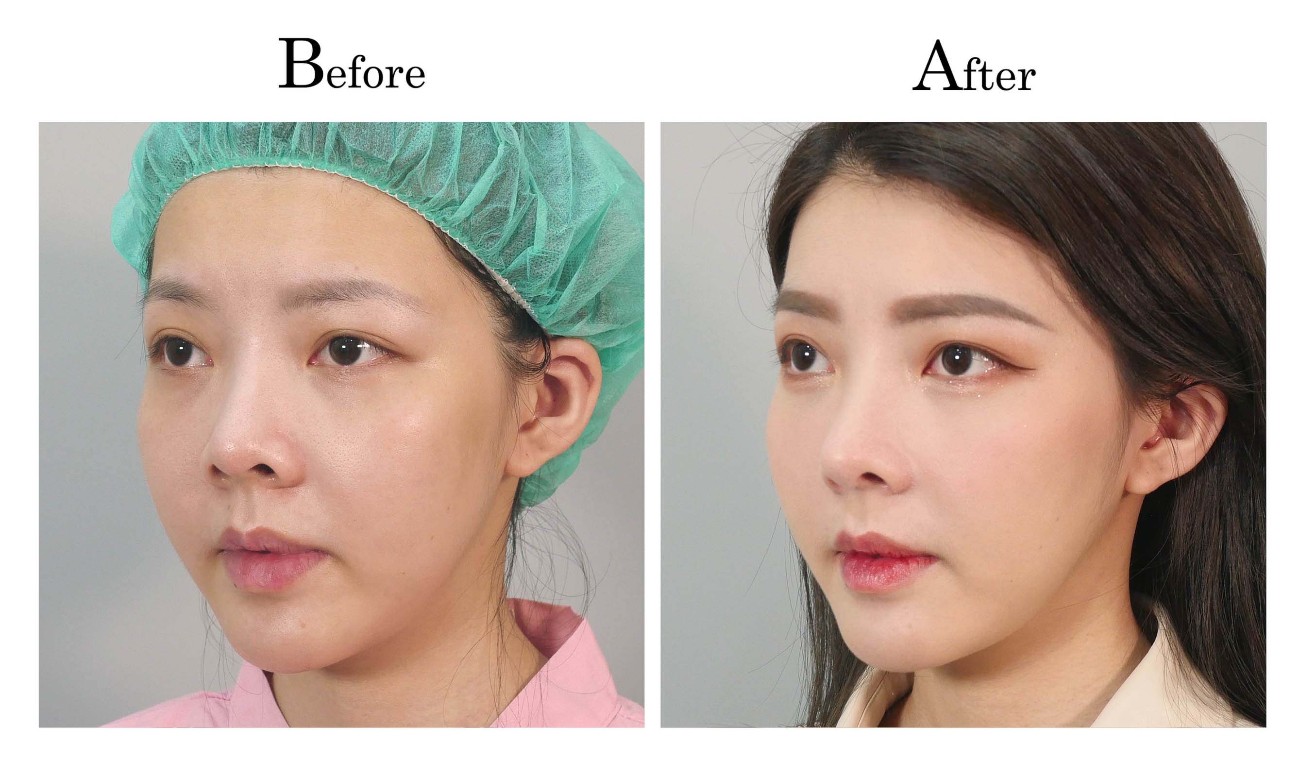 台中隆鼻手術,台中鼻整形,朱立箴隆鼻01_5