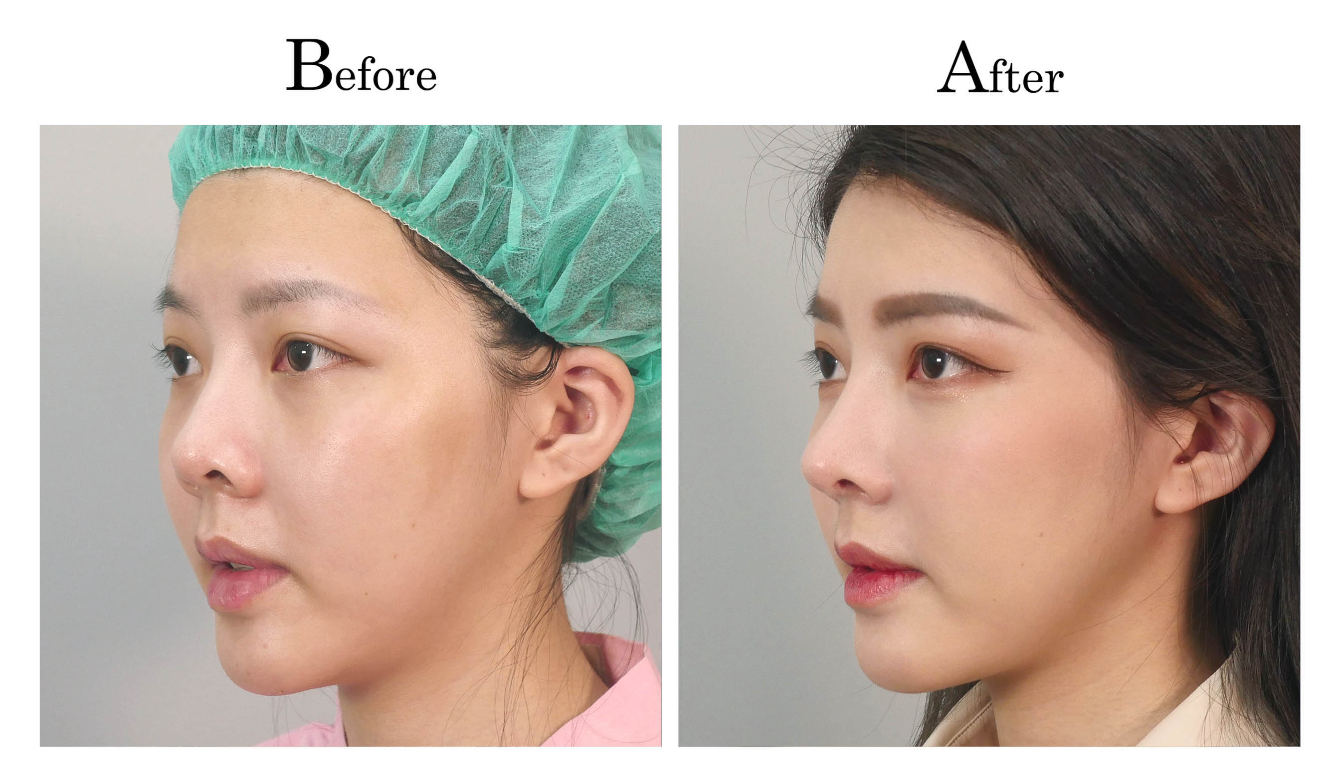 台中隆鼻手術,台中鼻整形,朱立箴隆鼻01_6