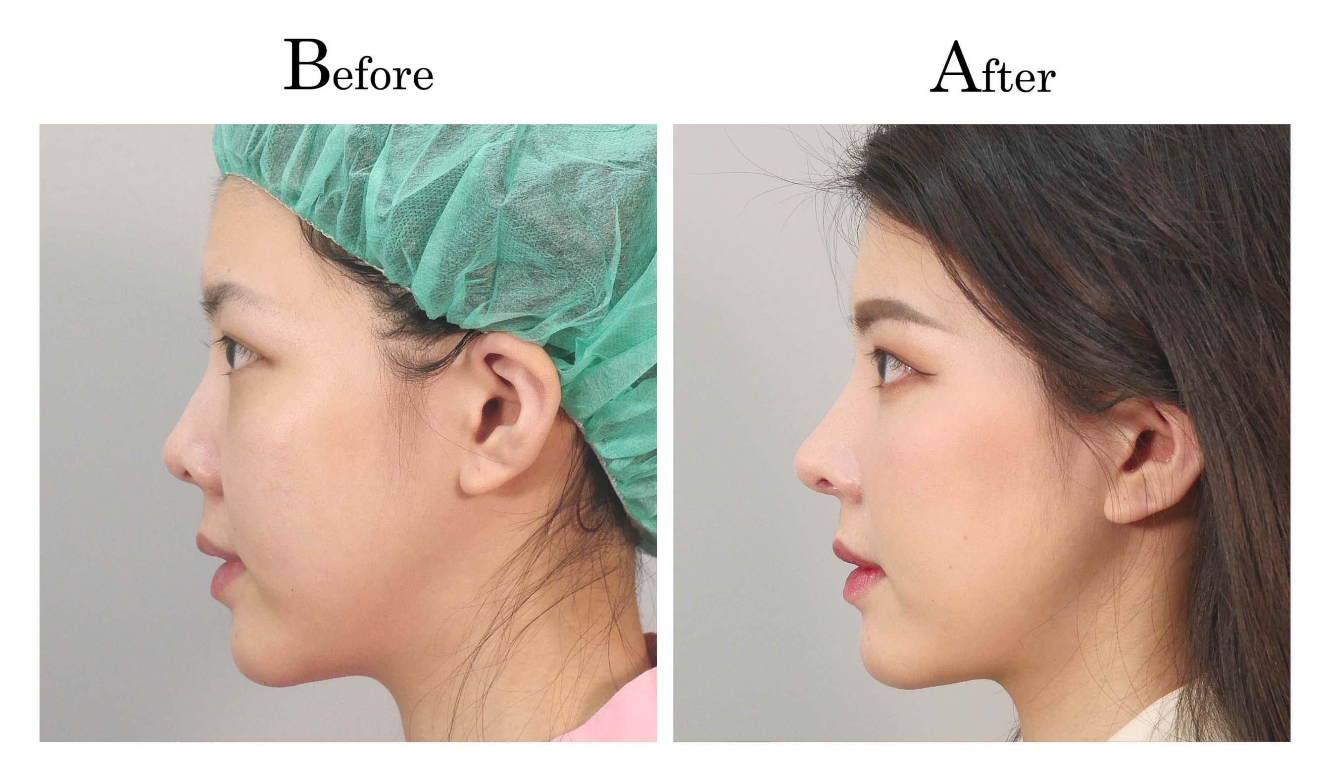 台中隆鼻手術,台中鼻整形,朱立箴隆鼻01_7