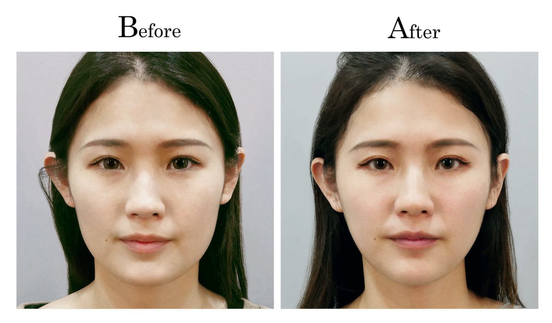 台中削骨,台中磨骨,台中下顎骨角磨骨,台中韓式微創削骨磨骨