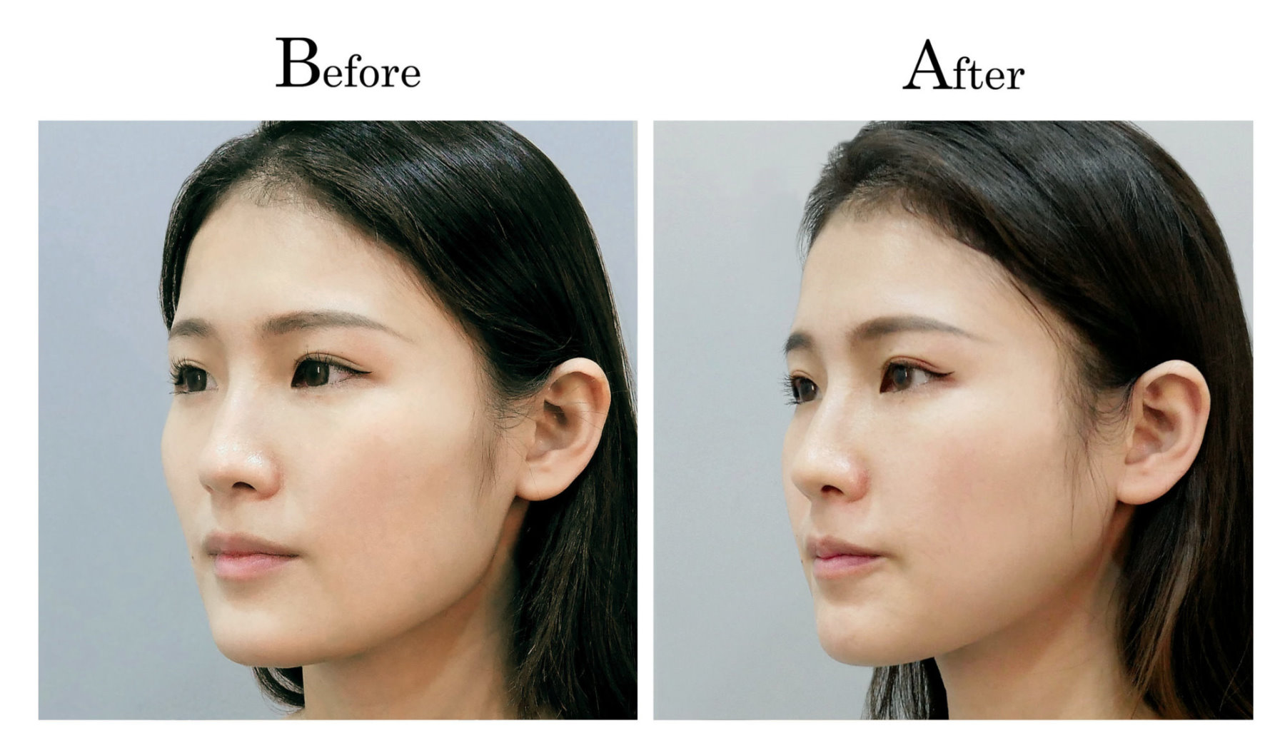 台中削骨,台中磨骨,台中下顎骨角磨骨,台中韓式微創削骨磨骨