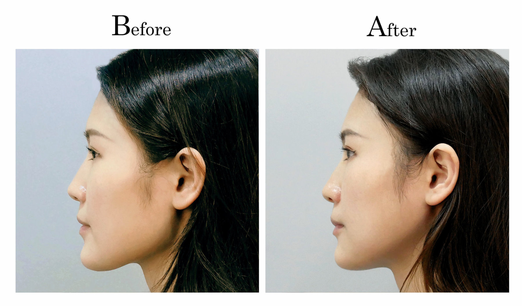 台中削骨,台中磨骨,台中下顎骨角磨骨,台中韓式微創削骨磨骨