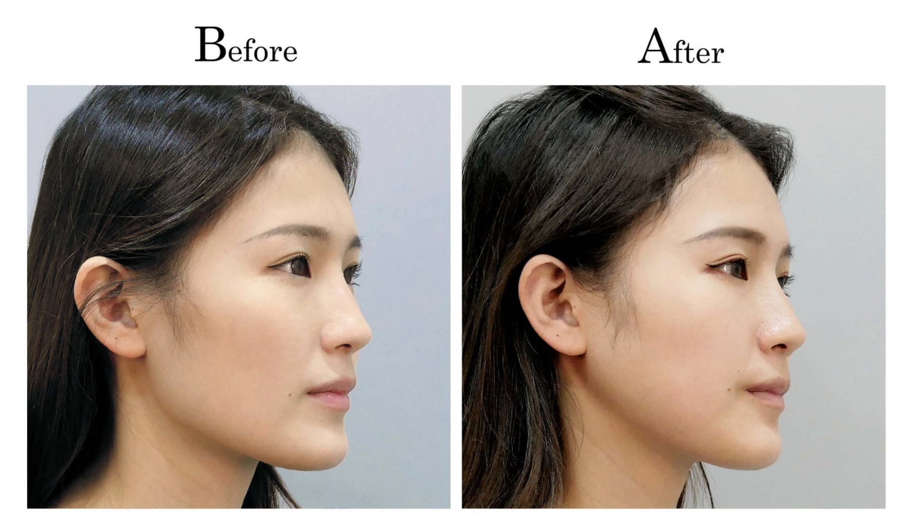 台中削骨,台中磨骨,台中下顎骨角磨骨,台中韓式微創削骨磨骨