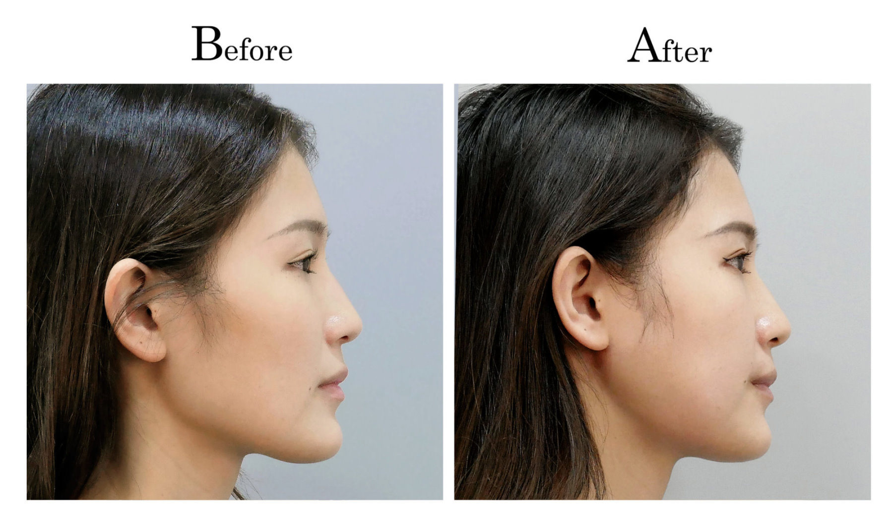 台中削骨,台中磨骨,台中下顎骨角磨骨,台中韓式微創削骨磨骨