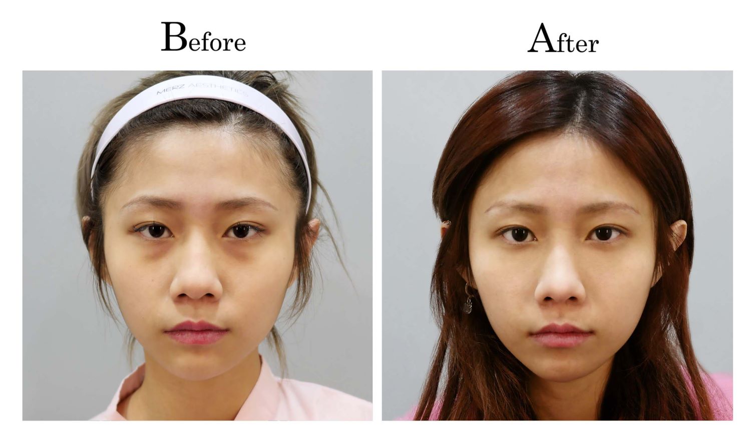 鼻頭塑型縮鼻頭手術案例何旭爵醫師001