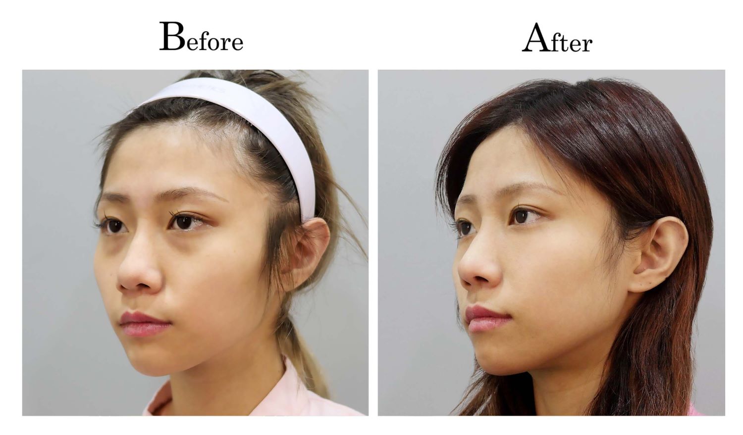 鼻頭塑型縮鼻頭手術案例何旭爵醫師002