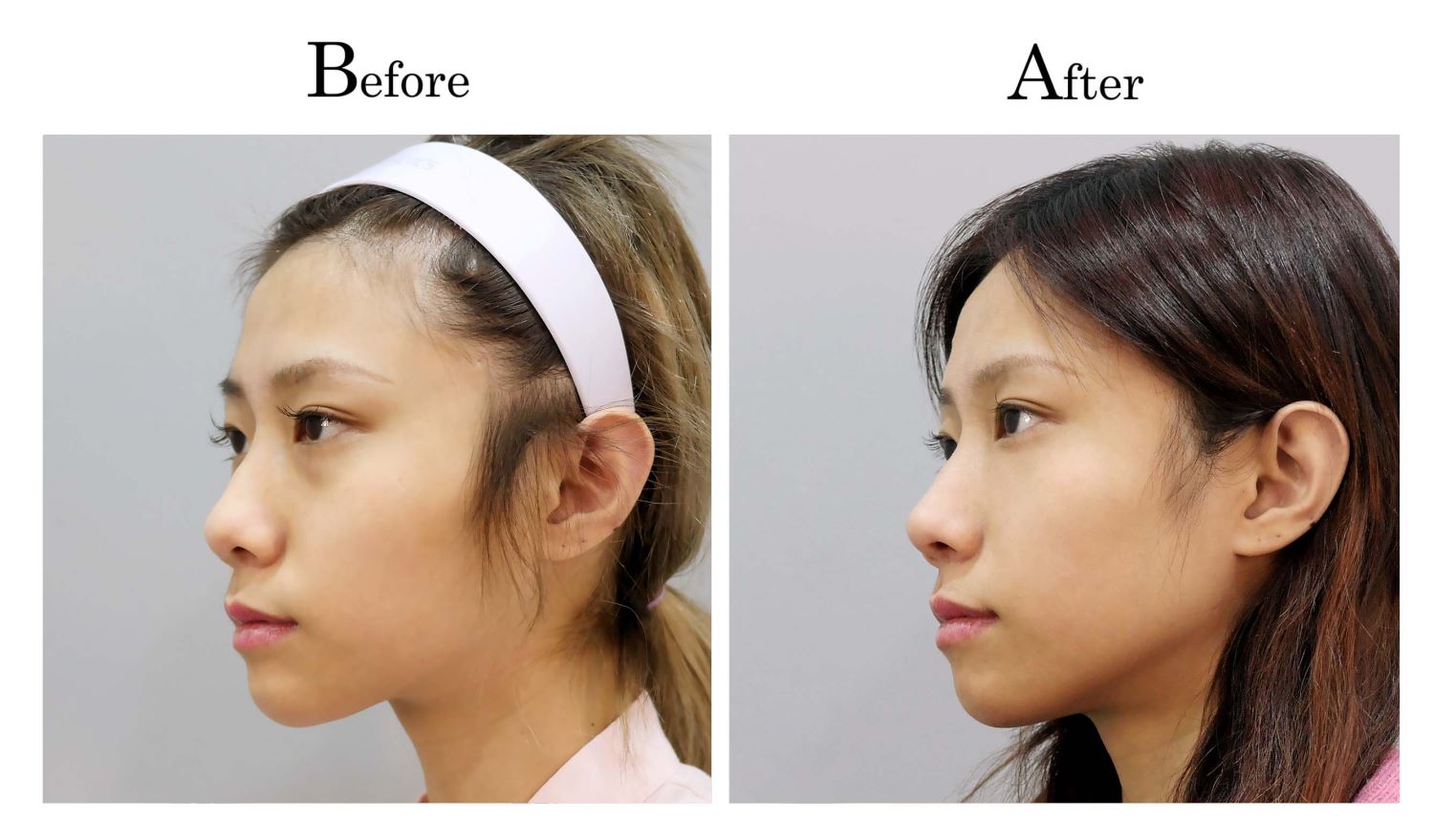 鼻頭塑型縮鼻頭手術案例何旭爵醫師003