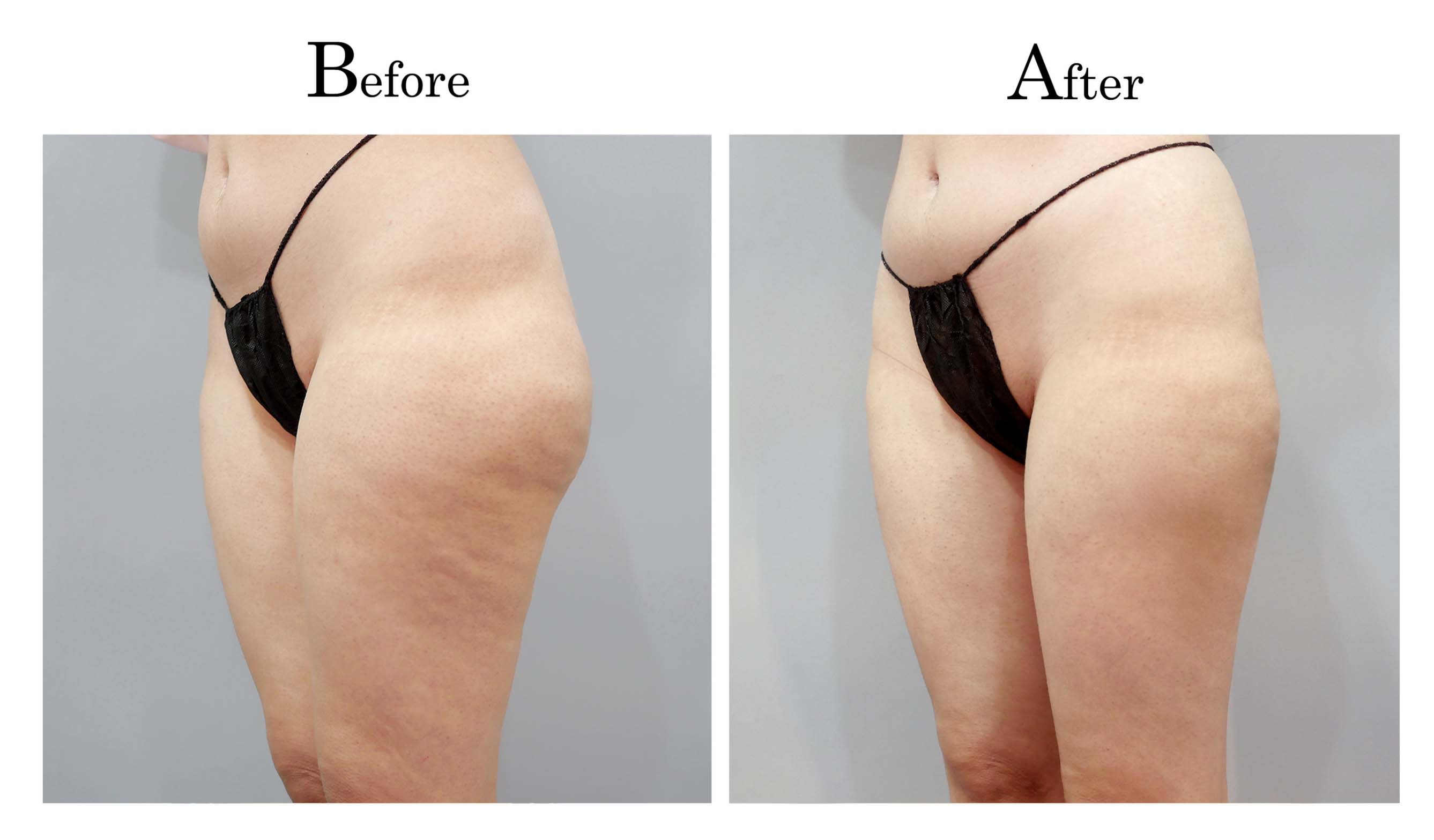 抽脂手術,困難抽脂,顯微套管抽脂,抽脂達人林仲樵002