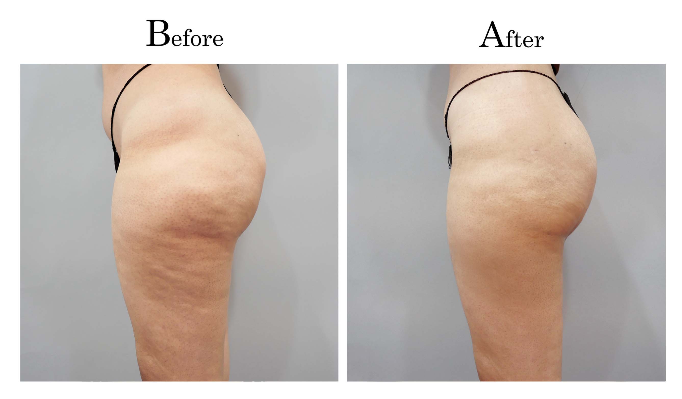 抽脂手術,困難抽脂,顯微套管抽脂,抽脂達人林仲樵003