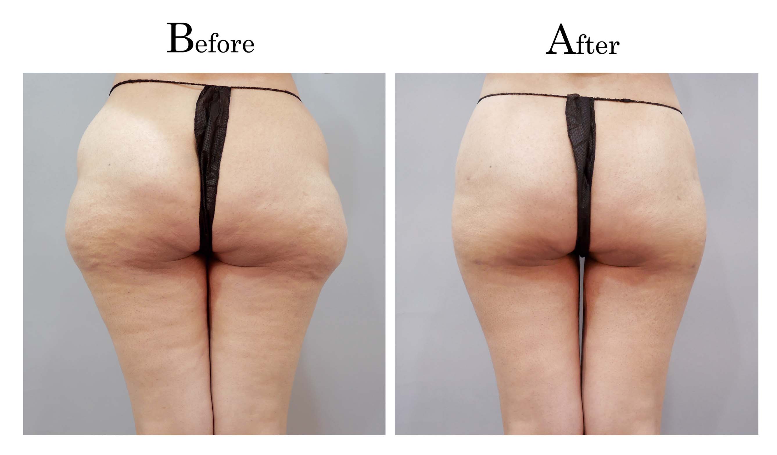 抽脂手術,困難抽脂,顯微套管抽脂,抽脂達人林仲樵004