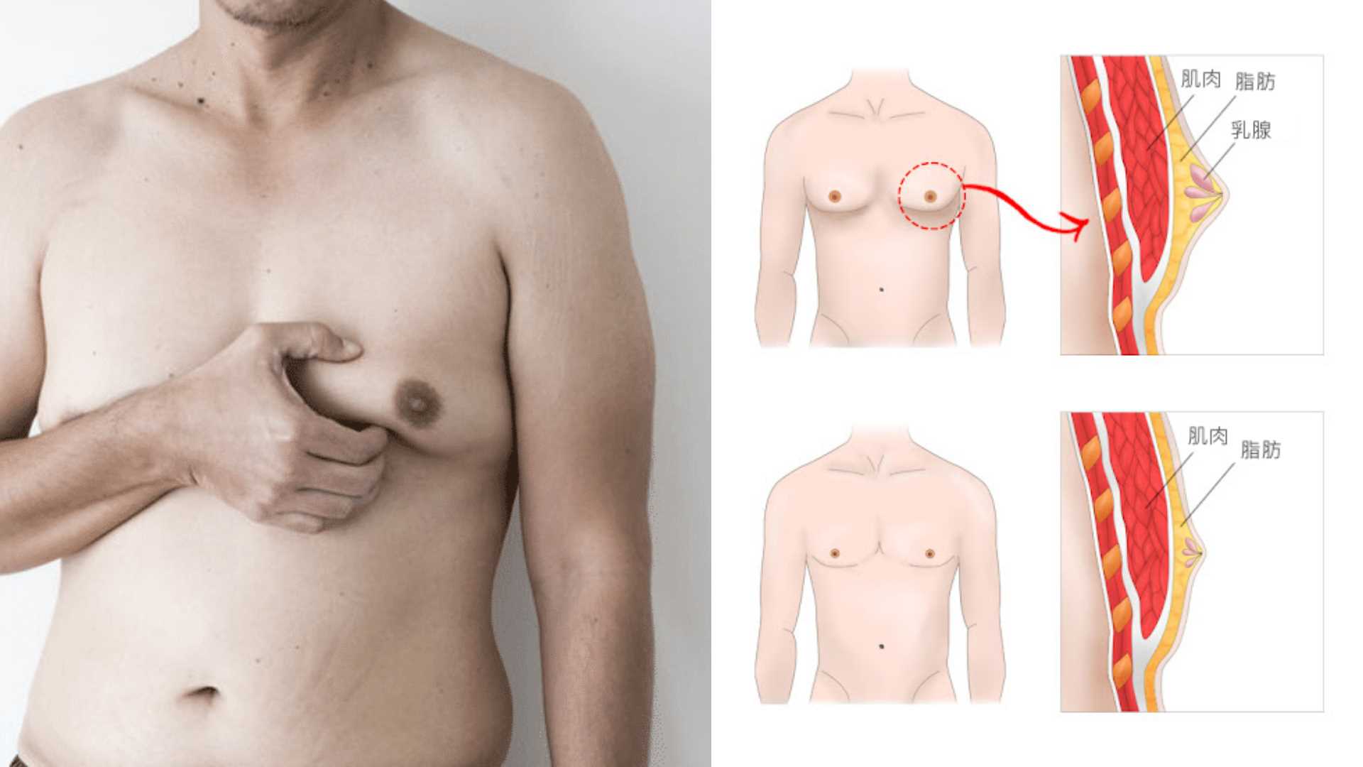 台中男性女乳症案例圖