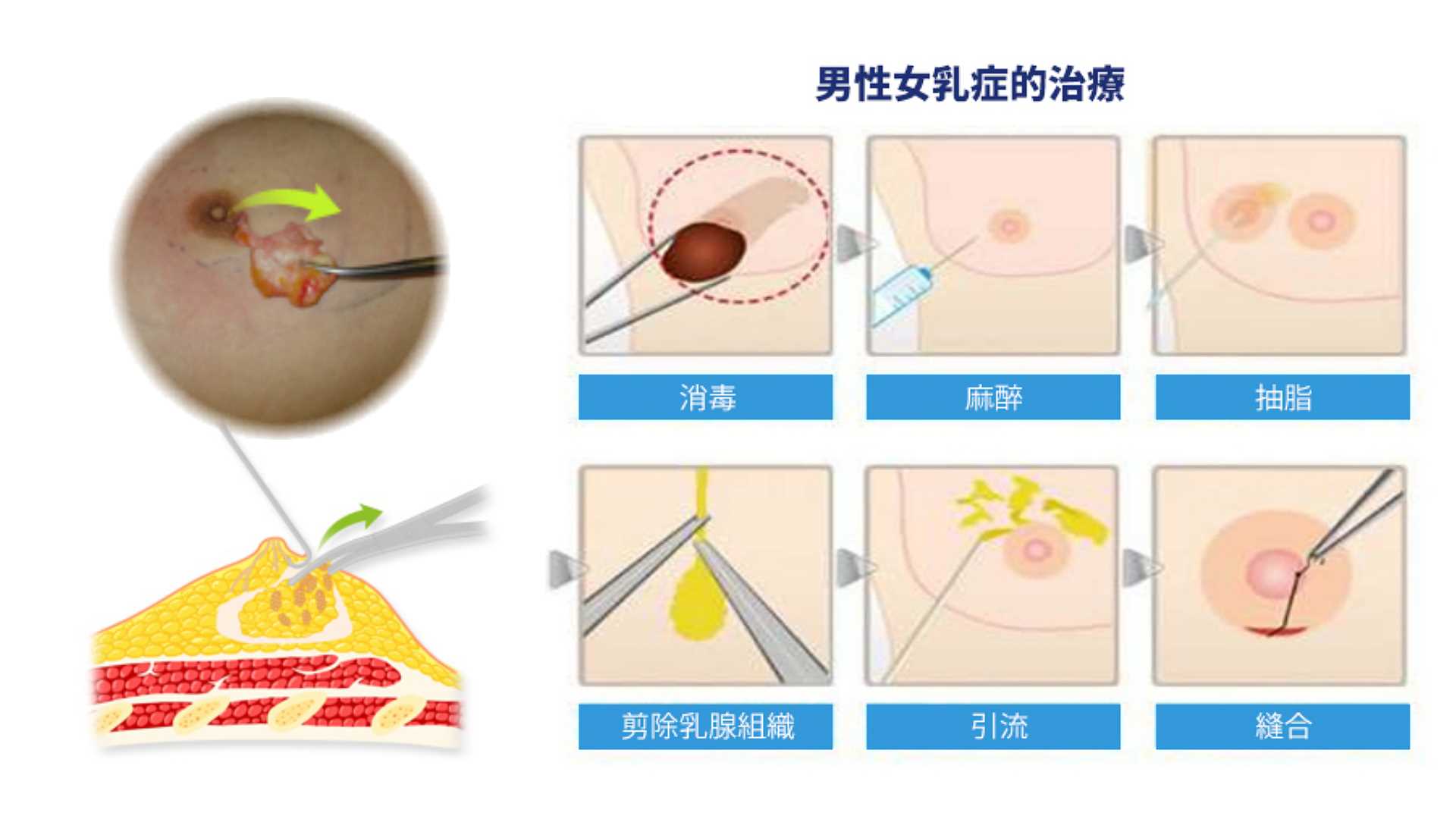 複合型男性女乳症手術示意圖2