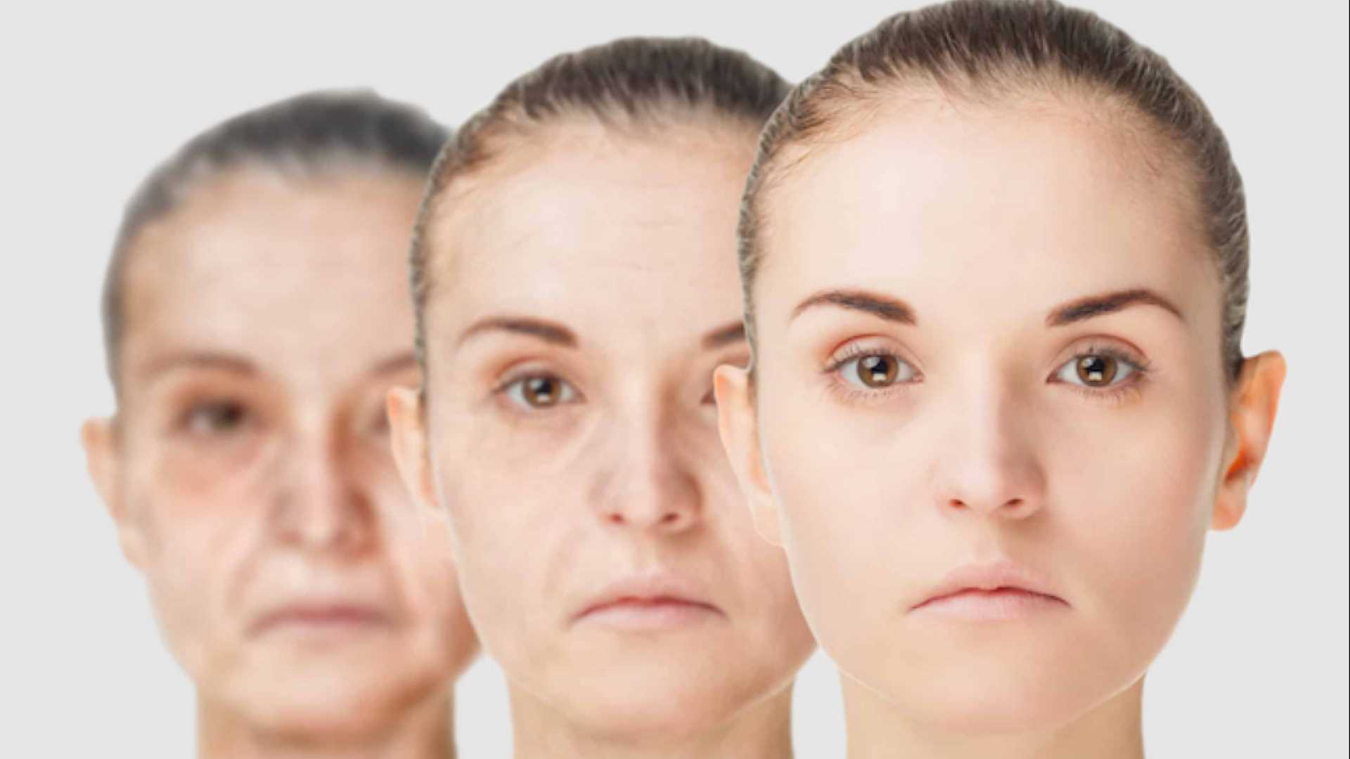 自體脂肪補臉改善老化