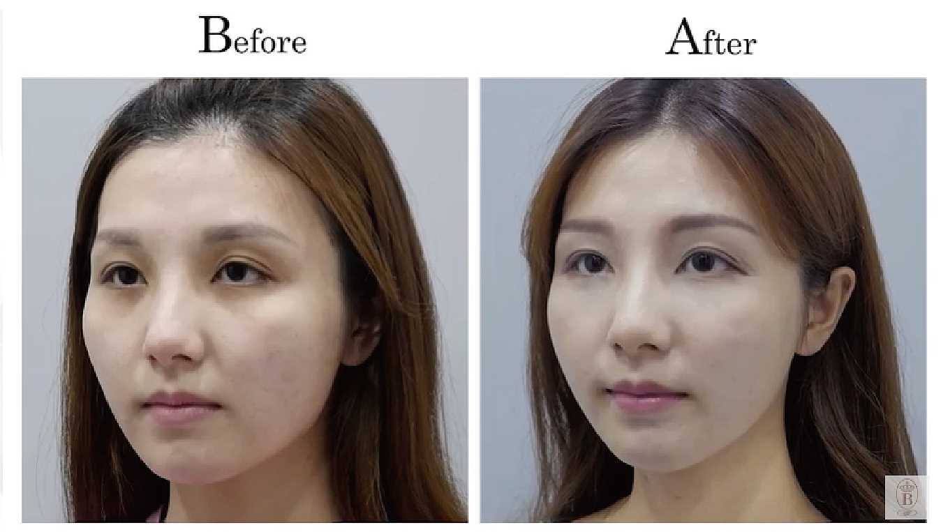 自體脂肪補臉手術案例